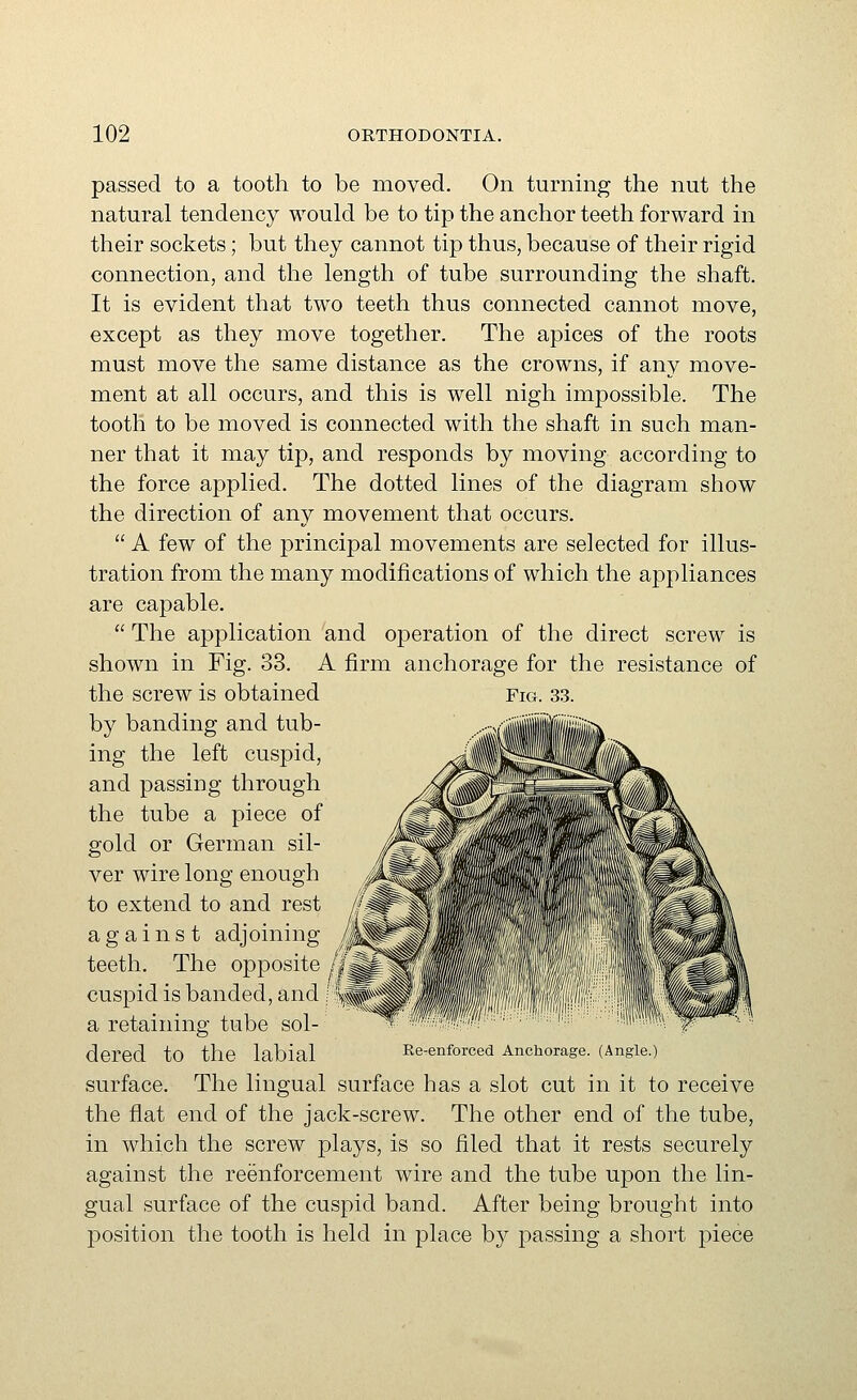 passed to a tooth to be moved. On turning the nut the natural tendency would be to tip the anchor teeth forward in their sockets; but they cannot tip thus, because of their rigid connection, and the length of tube surrounding the shaft. It is evident that two teeth thus connected cannot move, except as they move together. The apices of the roots must move the same distance as the crowns, if any move- ment at all occurs, and this is well nigh impossible. The tooth to be moved is connected with the shaft in such man- ner that it may tip, and responds by moving according to the force applied. The dotted lines of the diagram show the direction of any movement that occurs.  A few of the principal movements are selected for illus- tration from the many modifications of which the appliances are capable.  The application and operation of the direct screw is shown in Fig. 33. A firm anchorage for the resistance of the screw is obtained Fig. 33. by banding and tub- ing the left cuspid, and passing through the tube a piece of gold or German sil- ver wire long enough to extend to and rest against adjoining teeth. The opposite /|| cuspid is banded, and a retaining tube sol- dered to the labial Re-enforced Anchorage. (Angle.) surface. The lingual surface has a slot cut in it to receive the flat end of the jack-screw. The other end of the tube, in which the screw plays, is so filed that it rests securely against the reenforcement wire and the tube upon the lin- gual surface of the cuspid band. After being brought into position the tooth is held in place by j)assing a short piece