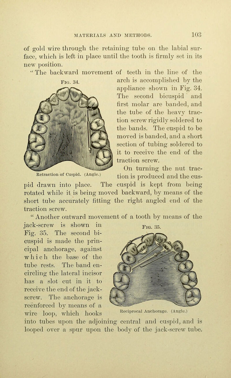 Fig. 34. Retraction of Cuspid. (Angle. of gold wire through the retaining tube on the labial sur- face, which is left in place until the tooth is firmly set in its new position. '' The backward movement of teeth in the line of the arch is accomplished by the appliance shown in Fig. 34. The second bicuspid and first molar are banded, and the tube of the heavy trac- tion screw rigidly soldered to the bands. The cuspid to be moved is banded, and a short section of tubing soldered to it to receive the end of the traction screw. On turning the nut trac- tion is produced and the cus- pid drawn into place. The cuspid is kept from being rotated while it is being moved backward, by means of the short tube accurately fitting the right angled end of the traction screw. Another outward movement of a tooth by means of the jack-screw is shown in Fig. 35. The second bi- cuspid is made the prin- cipal anchorage, against which the base of the tube rests. The band en- circling the lateral incisor has a slot cut in it to receive the end of the jack- screw. The anchorage is reenforced by means of a wire loop, which hooks into tubes upon the adjoining central and cuspid, and is looped over a spur upon the body of the jack-screw tube. Fig. 35. Reciprocal Anchorage. (Angle.)
