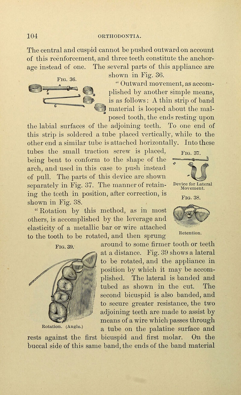 Fig. 37. The central and cuspid cannot be pushed outward on account of this reenforcement, and three teeth constitute the anchor- age instead of one. The several parts of this appliance are shown in Fig. 36.  Outward movement, as accom- plished by another simple means, is as follows: A thin strip of band material is looped about the mal- posed tooth, the ends resting upon the labial surfaces of the adjoining teeth. To one end of this strip is soldered a tube placed vertically, while to the other end a similar tube is attached horizontally. Into these tubes the small traction screw is placed, being bent to conform to the shape of the arch, and used in this case to push instead of pull. The parts of this device are shown separately in Fig. 37. The manner of retain- ing the teeth in position, after correction, is shown in Fig. 38.  Rotation by this method, as in most others, is accomplished by the leverage and elasticity of a metallic bar or wire attached to the tooth to be rotated, and then sprung around to some firmer tooth or teeth at a distance. Fig. 39 shows a lateral to be rotated, and the appliance in position by which it may be accom- plished. The lateral is banded and tubed as shown in the cut. The second bicuspid is also banded, and to secure greater resistance, the two adjoining teeth are made to assist by means of a wire which passes through a tube on the palatine surface and rests against the first bicuspid and first molar. On the buccal side of this same band, the ends of the band material Device for Lateral Movement. Fig. 38. Retention. Fig. 39. Rotation. (Angle.)