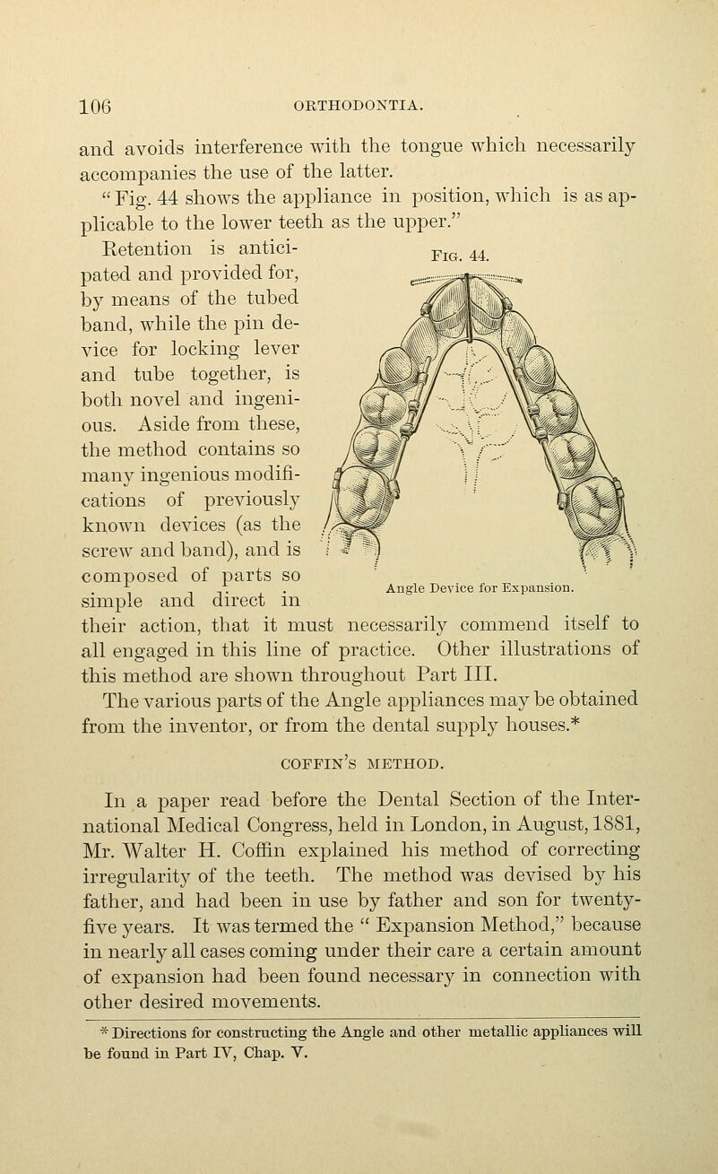 Fig. 44. and avoids interference with the tongue which necessarily accompanies the use of the latter. Fig. 44 shows the appliance in position, which is as ap- plicable to the lower teeth as the upper. Retention is antici- pated and provided for, by means of the tubed band, while the pin de- vice for locking lever and tube together, is both novel and ingeni- ous. Aside from these, the method contains so many ingenious modifi- cations of previouslj^ known devices (as the screw and band), and is composed of parts so simple and direct in their action, that it must necessarily commend itself to all engaged in this line of practice. Other illustrations of this method are shown throughout Part III. The various parts of the Angle appliances may be obtained from the inventor, or from the dental supply houses.* coffin's method. In a paper read before the Dental Section of the Inter- national Medical Congress, held in London, in August, 1881, Mr. Walter H. Coffin explained his method of correcting irregularity of the teeth. The method was devised by his father, and had been in use by father and son for twenty- five years. It was termed the  Expansion Method, because in nearly all cases coming under their care a certain amount of expansion had been found necessary in connection with other desired movements. * Directions for constmctuig the Angle and other metallic appliances will be found in Part IV, Chap. V. Angle Device for Expansion.