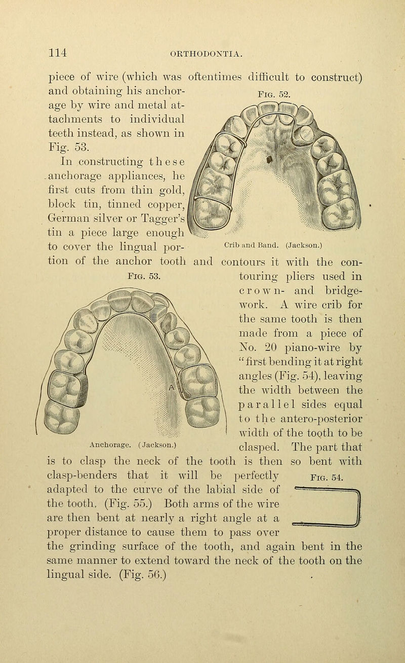 Fig. 52. piece of wire (whicli was oftentimes difficult to construct) and obtaining his anchor- age by wire and metal at- tachments to individual teeth instead, as shown in Fig. 53. In constructing these .anchorage appliances, he first cuts from thin gold, block tin, tinned copper, German silver or Tagger's tin a piece large enough to cover the lingual por- tion of the anchor tooth and contours it with the con- pliers used in and bridge- work. A wire crib for the same tooth is then made from a piece of No. 20 piano-wire by '' first bending it at right angles (Fig. 54), leaving the width between the parallel sides equal to the antero-posterior width of the tooth to be clasped. The part that so bent with Fig. 53. Crib and Band. (Jackson.^ touring- crow n Fig. 54. Anchorage. (Jackson.) is to clasp the neck of the tooth is then clasp-benders that it will be perfectly adapted to the curve of the labial side of the tooth, (Fig. 55.) Both arms of the wire are then bent at nearly a right angle at a proper distance to cause them to pass over the grinding surface of the tooth, and again bent in the same manner to extend toward the neck of the tooth on the lingual side. (Fig. 56.)