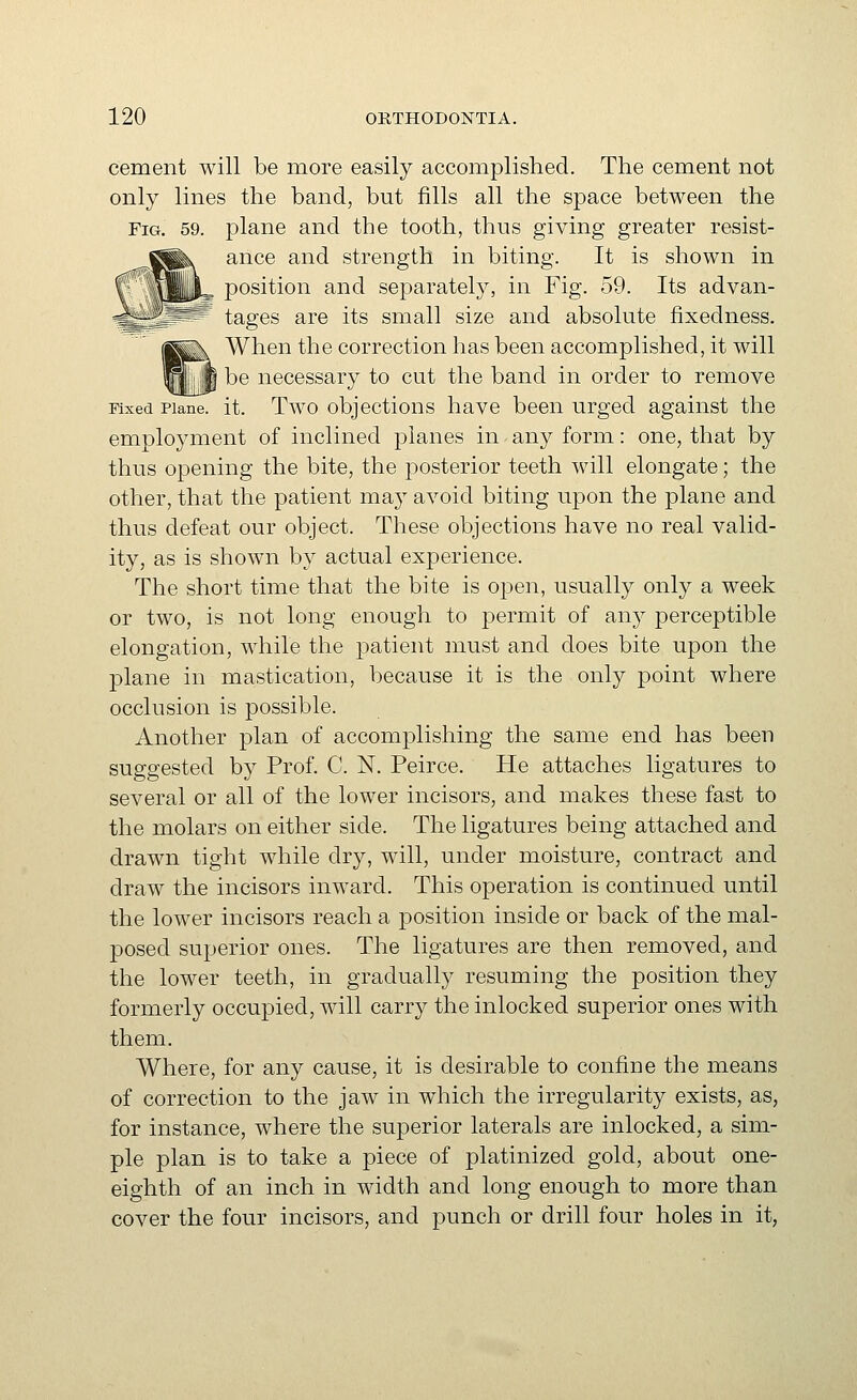 cement will be more easily accomplished. The cemient not only lines the band, but fills all the space between the Fig. 59. plane and the tooth, thus giving greater resist- ance and strength in biting. It is shown in position and separately, in Fig. 59. Its advan- tages are its small size and absolute fixedness. When the correction has been accomplished, it will be necessary to cut the band in order to remove Mxed Plane, it. Two objections have been urged against the employment of inclined planes in any form: one, that by thus opening the bite, the 2:)osterior teeth will elongate; the other, that the patient may avoid biting upon the plane and thus defeat our object. These objections have no real valid- ity, as is shown by actual experience. The short time that the bite is open, usually only a week or two, is not long enough to permit of any perceptible elongation, while the patient must and does bite upon the plane in mastication, because it is the only point where occlusion is possible. Another plan of accomplishing the same end has been suggested by Prof. C. N. Peirce. He attaches ligatures to several or all of the lower incisors, and makes these fast to the molars on either side. The ligatures being attached and drawn tight while dry, will, under moisture, contract and draw the incisors inward. This operation is continued until the lower incisors reach a position inside or back of the mal- posed superior ones. The ligatures are then removed, and the lower teeth, in gradually resuming the position they formerly occupied, will carry the inlocked superior ones with them. Where, for any cause, it is desirable to confine the means of correction to the jaw in which the irregularity exists, as, for instance, where the superior laterals are inlocked, a sim- ple plan is to take a piece of platinized gold, about one- eighth of an inch in width and long enough to more than cover the four incisors, and punch or drill four holes in it,