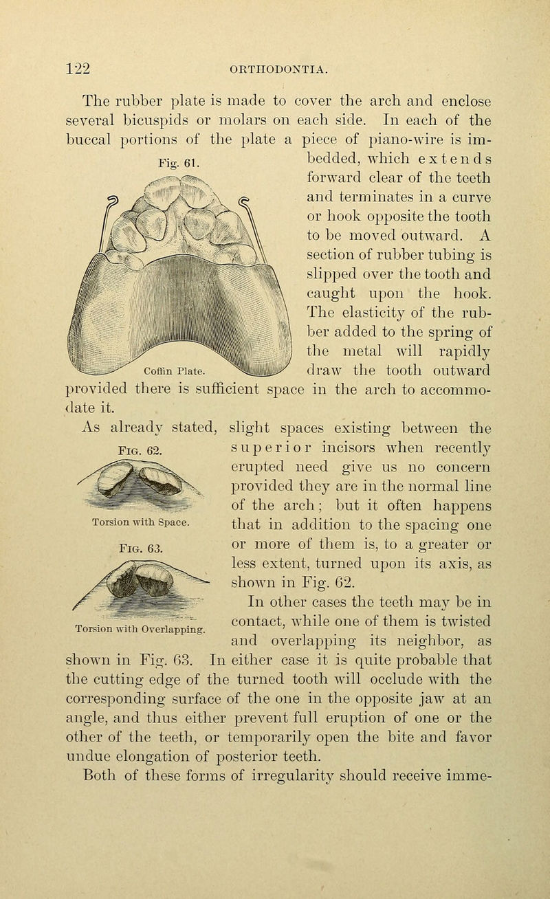 Fio. 61. The rubber plate is made to cover the arch and enclose several bicuspids or molars on each side. In each of the buccal portions of the plate a piece of piano-wire is im- bedded, which extends forward clear of the teeth and terminates in a curve or hook opposite the tooth to be moved outward. A section of rubber tubing is slijDped over the tooth and caught upon the hook. The elasticity of the rub- ber added to the spring of the metal will rapidly draw the tooth outward provided there is sufficient space in the arch to accommo- date it. slight spaces existing between the superior incisors when recently erujited need give us no concern provided they are in the normal line of the arch; but it often happens that in addition to the spacing one or more of them is, to a greater or less extent, turned upon its axis, as shown in Fig. 62. In other cases the teeth may be in contact, while one of them is twisted and overlapping its neighbor, as shown in Fig. 63. In either case it is quite probable that the cutting edge of the turned tooth will occlude with the corresponding surface of the one in the opposite jaw at an angle, and thus either prevent full eruption of one or the other of the teeth, or temporarily open the bite and favor undue elongation of posterior teeth. Both of these forms of irregularity should receive imme- As already stated, Fig. 62. Torsion with Space. Fig. 63. Torsion with Overlapping.