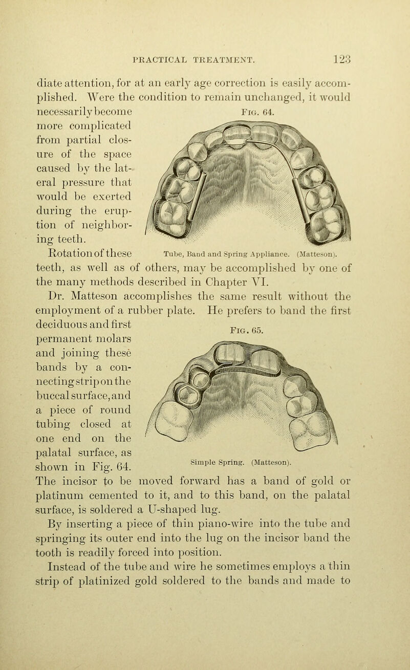 diate attention, for at an early age correction is easily accom- i^lished. Were the condition to remain unchanged, it would necessarily become Fig. 64. more complicated ^ ^-^^if^^ from partial clos- Zl( _^ _J^-^r~~^'J' ure of the space caused by the lat- eral pressure that would be exerted during the erup- tion of neighbor- ing teeth. Rotation of these Tube, Band and Spring Appliance. (Matteson). teeth, as well as of others, may be accomplished by one of the many methods described in Chapter VI. Dr. Matteson accomplishes the same result without the employment of a rubber plate. He prefers to band the first deciduous and first „ Fig. 65. permanent molars and joining these bands by a con- necting strip on the buccal surface, and a piece of round tubing closed at one end on the palatal surface, as shown in Fig. 64. The incisor to be moved forward has a band of gold or platinum cemented to it, and to this band, on the palatal surface, is soldered a U-shaped lug. By inserting a piece of thin piano-wire into the tube and springing its outer end into the lug on the incisor band the tooth is readily forced into position. Instead of the tulje and Avire he sometimes employs a thin strip of platinized gold soldered to the bands and made to Simple Spring. (Matteson).