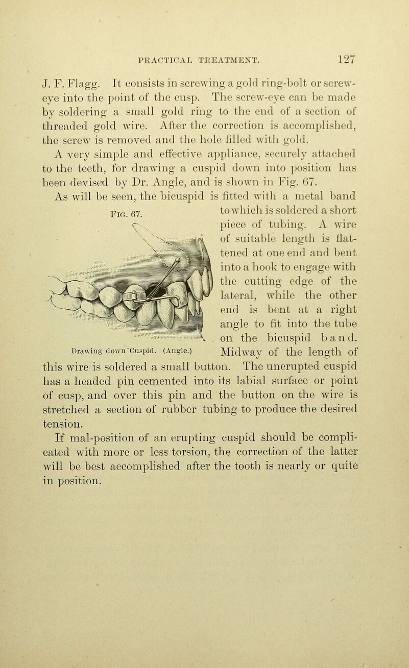 J. F. Flagg. It consists in screwing a gold ring-bolt or screw- eye into the point of the cusp. The screw-eye can be made by soldering a small gold ring to the end of a section of threaded gold wire. After the correction is accomplished, the screw is removed and the hole filled with gold. A very simple and effective appliance, securely attached to the teeth, for drawing a cuspid down into position has been devised by Dr. Angle, and is shown in Fig. 07. As will be seen, the bicuspid is fitted with a metal band piece of tubing. A wire of suitable length is flat- tened at one end and bent into a hook to engage with the cutting edge of the lateral, while the other end is bent at a right angle to fit into the tube ^K , on the bicuspid band. Drawing down-Cuspid. (Angle.) Midway of the length of this wire is soldered a small button. The unerupted cuspid has a headed pin cemented into its labial surface or point of cusp, and over this pin and the button on the wire is stretched a section of rubber tubing to produce the desired tension. If mal-position of an erupting cuspid should be compli- cated with more or less torsion, the correction of the latter will be best accomplished after the tooth is nearly or quite in position.