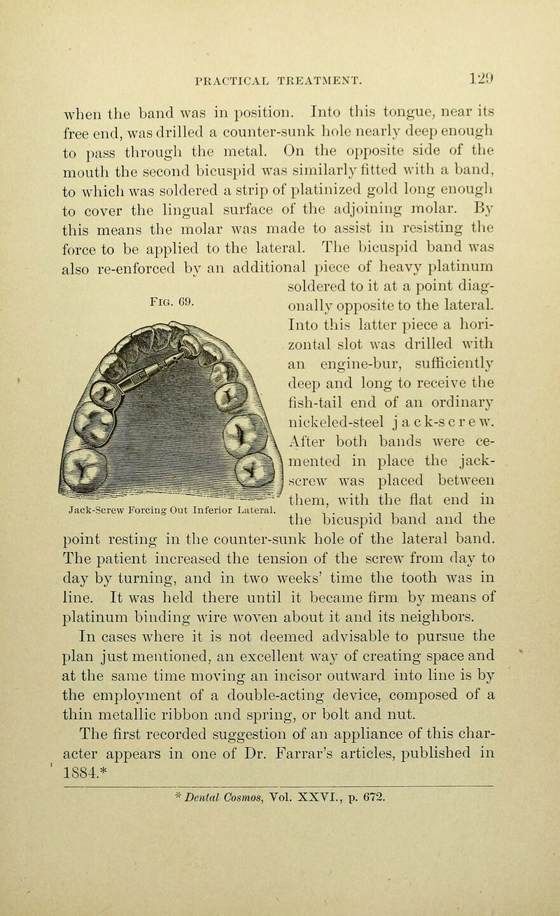 when the band was in position. Into this tongue, near its free end, was drilled a counter-sunk hole nearly deep enough to pass through the metal. On the opposite side of the mouth the second bicuspid was similarly fitted with a band, to which was soldered a strip of platinized gold long enough to cover the lingual surface of the adjoining molar. By this means the molar was made to assist in resisting the force to be applied to the lateral. The bicuspid band was also re-enforced by an additional piece of heavy platinum soldered to it at a point diag- ^^^- ^^- onally opposite to the lateral. Into this latter piece a hori- zontal slot was drilled with an engine-bur, sufficiently deep and long to receive the fish-tail end of an ordinary nickeled-steel j a c k-s crew. After both bands were ce- mented in place the jack- screw was placed between them, with the flat end in the bicuspid band and the point resting in the counter-sunk hole of the lateral band. The patient increased the tension of the screw from day to day by turning, and in two weeks' time the tooth was in line. It was held there until it became firm by means of platinum binding wire woven about it and its neighbors. In cases where it is not deemed advisable to pursue the plan just mentioned, an excellent way of creating space and at the same time moving an incisor outward into line is by the employment of a double-acting device, composed of a thin metallic ribbon and spring, or bolt and nut. The first recorded suggestion of an appliance of this char- acter appears in one of Dr. Farrar's articles, published in 1884.* Jack-Screw Forcing Out Inferior Lateral.