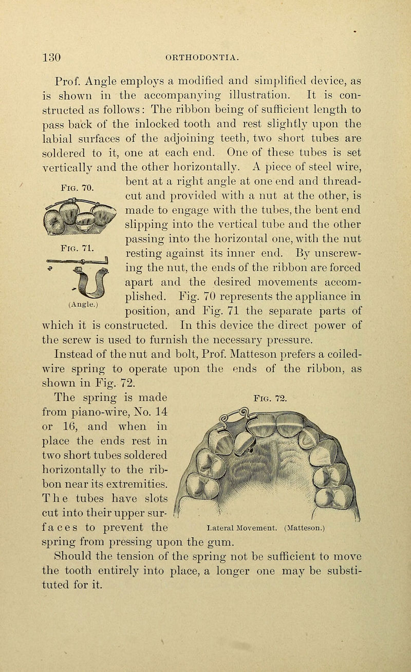 Fig. 70. (Angle.) Prof. Angle employs a modified and simplified device, as is shown in the accompanying illustration. It is con- structed as follows: The ribbon being of sufficient length to pass back of the inlocked tooth and rest slightly upon the labial surfaces of the adjoining teeth, two short tubes are soldered to it, one at each end. One of these tubes is set vertically and the other horizontally. A piece of steel wire, bent at a right angle at one end and thread- cut and j^rovided with a nut at the other, is made to engage with the tubes, the bent end slipping into the vertical tube and the other passing into the horizontal one, with the nut resting against its inner end. By unscrew- ing the nut, the ends of the ribbon are forced apart and the desired movements accom- plished. Fig. 70 represents the appliance in position, and Fig. 71 the separate parts of which it is constructed. In this device the direct power of the screw is used to furnish the necessary pressure. Instead of the nut and bolt, Prof. Matteson prefers a coiled- wire spring to operate upon the ends of the ribbon, as shown in Fig. 72. from piano-wire, No. 14 or 16, and when in place the ends rest in two short tubes soldered horizontally to the rib- bon near its extremities. The tubes have slots cut into their upper sur- faces to prevent the Lateral Movement. (Matteson.) spring from pressing upon the gum. Should the tension of the spring not be sufficient to move the tooth entirely into place, a longer one may be substi- tuted for it.