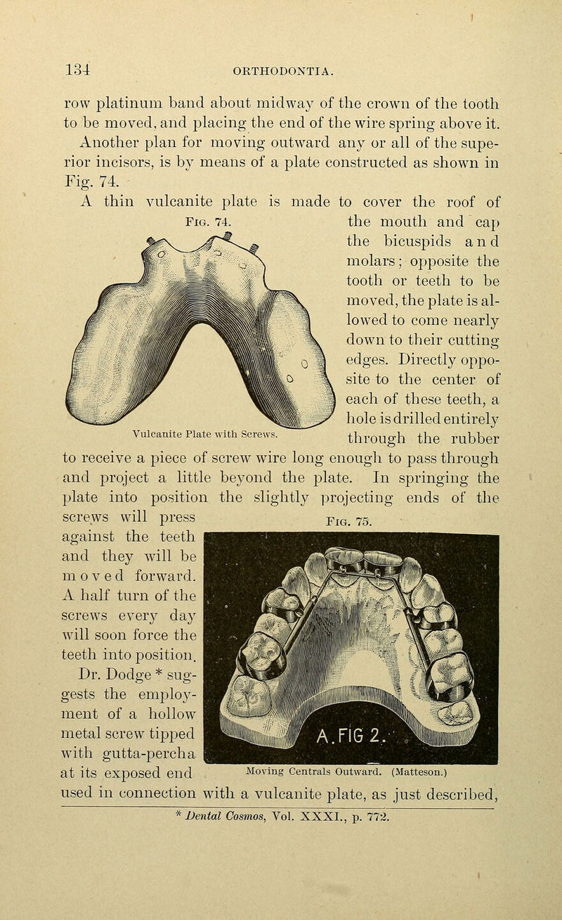 row platinum band about midway of the crown of the tooth to be moved, and placing the end of the wire spring above it. Another plan for moving outward any or all of the supe- rior incisors, is by means of a plate constructed as shown in Fig. 74. A thin vulcanite plate Fig. 74. IS Vulcanite Plate with Screws. made to cover the roof of the mouth and cap the bicuspids and molars; opposite the tooth or teeth to be moved, the plate is al- lowed to come nearly down to their cutting edges. Directly oppo- site to the center of each of these teeth, a hole is drilled entirely through the rubber to receive a piece of screw wire long enough to pass through and project a little beyond the i^late. In springing the plate into position the slightly projecting ends of the screws will press yig. 75. against the teeth and they will be moved forward. A half turn of the screws every day will soon force the teeth into position. Dr. Dodge * sug- gests the employ- ment of a hollow metal screw tipped with gutta-percha at its exposed end Moving centrals Outward. (Matteson.) used in connection with a vulcanite plate, as just described,