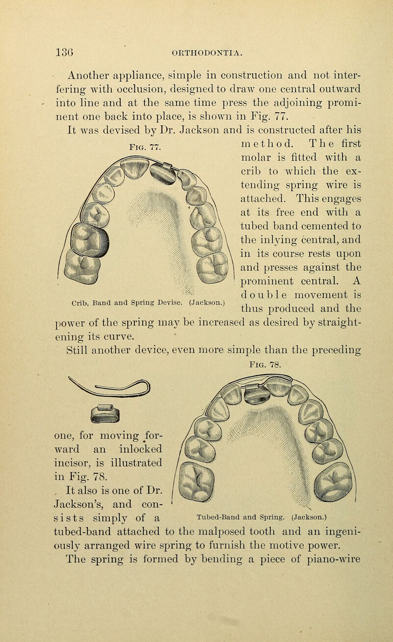 Fig. 77. Another appliance, simple in construction and not inter- fering with occlusion, designed to draw one central outward into line and at the same time press the adjoining promi- nent one back into place, is shown in Fig. 77. It was devised by Dr. Jackson and is constructed after his method. The first molar is fitted with a crib to which the ex- tending spring wire is attached. This engages at its free end with a tubed band cemented to the inlying central, and in its course rests upon and presses against the prominent central. A double movement is thus produced and the power of the spring may be increased as desired by straight- ening its curve. Still another device, even more simple than the preceding Fig. 78. Crib, Band and Spring Devise. (Jackson.) one, for moving ^for- ward an inlocked incisor, is illustrated in Fig. 78. It also is one of Dr. Jackson's, and con- S i S t S simply of a Tubed-Band and Spring. (Jackson.) tubed-band attached to the malposed tooth and an ingeni- ously arranged wire spring to furnish the motive power. The spring is formed by bending a piece of piano-wire