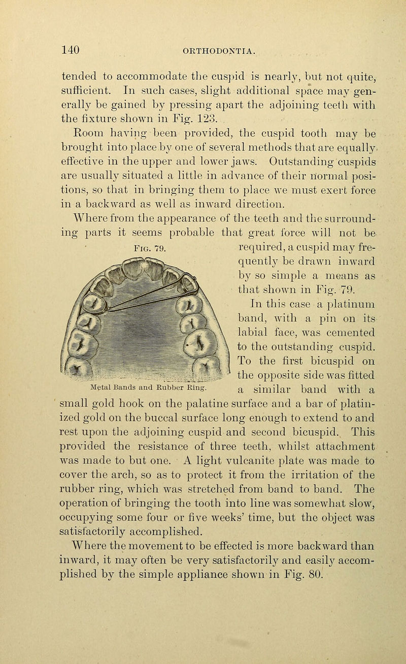 tended to accommodate the cuspid is nearly, but not quite, sufficient. In such cases, slight additional space may gen- erally be gained by pressing apart the adjoining teeth with the fixture shown in Fig. 123. Room having been provided, the cuspid tooth may be brought into place by one of several methods that are equally, effective in the upper and lower jaws. Outstanding cuspids are usually situated a little in advance of their normal posi- tions, so that in bringing them to place we must exert force in a backward as well as inward direction. Where from the appearance of the teeth and the surround- ing parts it seems probable that great force will not be required, a cuspid may fre- quently be drawn inward by so simple a means as that shown in Fig. 79. In this case a platinum band, with a pin on its labial face, was cemented to the outstanding cuspid. To the first bicuspid on the opposite side was fitted a similar band with a small gold hook on the palatine surface and a bar of platin- ized gold on the buccal surface long enough to extend to and rest upon the adjoining cuspid and second bicuspid. This provided the resistance of three teeth, whilst attachment was made to but one. A light vulcanite plate was made to cover the arch, so as to protect it from the irritation of the rubber ring, which was stretched from band to band. The operation of bringing the tooth into line was somewhat slow, occupying some four or five weeks' time, but the object was satisfactorily accomplished. Where the movement to be effected is more backward than inward, it may often be very satisfactorily and easily accom- plished by the simple appliance shown in Fig. 80. Ml t il 1 N mil lail 1 1 ian-