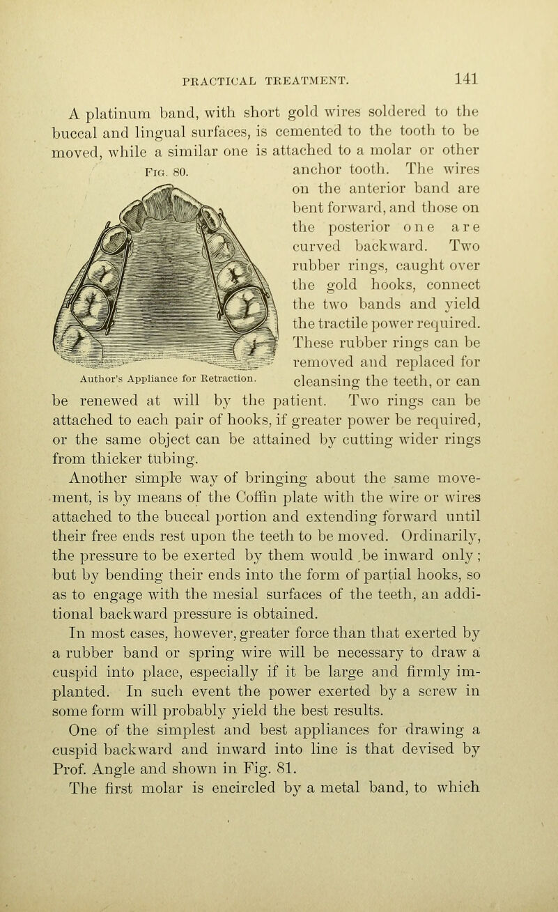 Fig. 80. A platinum band, with short gold wires soldered to the buccal and lingual surfaces, is cemented to the tooth to be moved, while a similar one is attached to a molar or other anchor tooth. The wires on the anterior band are bent forward, and those on the posterior one are curved backward. Two rubber rings, caught over the gold hooks, connect the two bands and yield the tractile power required. These rubber rings can be removed and replaced for Author's Appliance for Retraction. clcansing the tcCth, Or Can be renewed at will by the patient. Two rings can be attached to each pair of hooks, if greater power be required, or the same object can be attained by cutting wider rings from thicker tubing. Another simple way of bringing about the same move- ment, is by means of the Coffin plate with the wire or wires attached to the buccal portion and extending forward until their free ends rest upon the teeth to be moved. Ordinarily, the pressure to be exerted by them would ,be inward only; but by bending their ends into the form of partial hooks, so as to engage with the mesial surfaces of the teeth, an addi- tional backward pressure is obtained. In most cases, however, greater force than that exerted by a rubber band or spring wire will be necessary to draw a cuspid into place, especially if it be large and firmly im- planted. In such event the power exerted by a screw in some form will probably yield the best results. One of the simplest and best appliances for drawing a cuspid backward and inward into line is that devised by Prof. Angle and shown in Fig. 81. The first molar is encircled by a metal band, to which