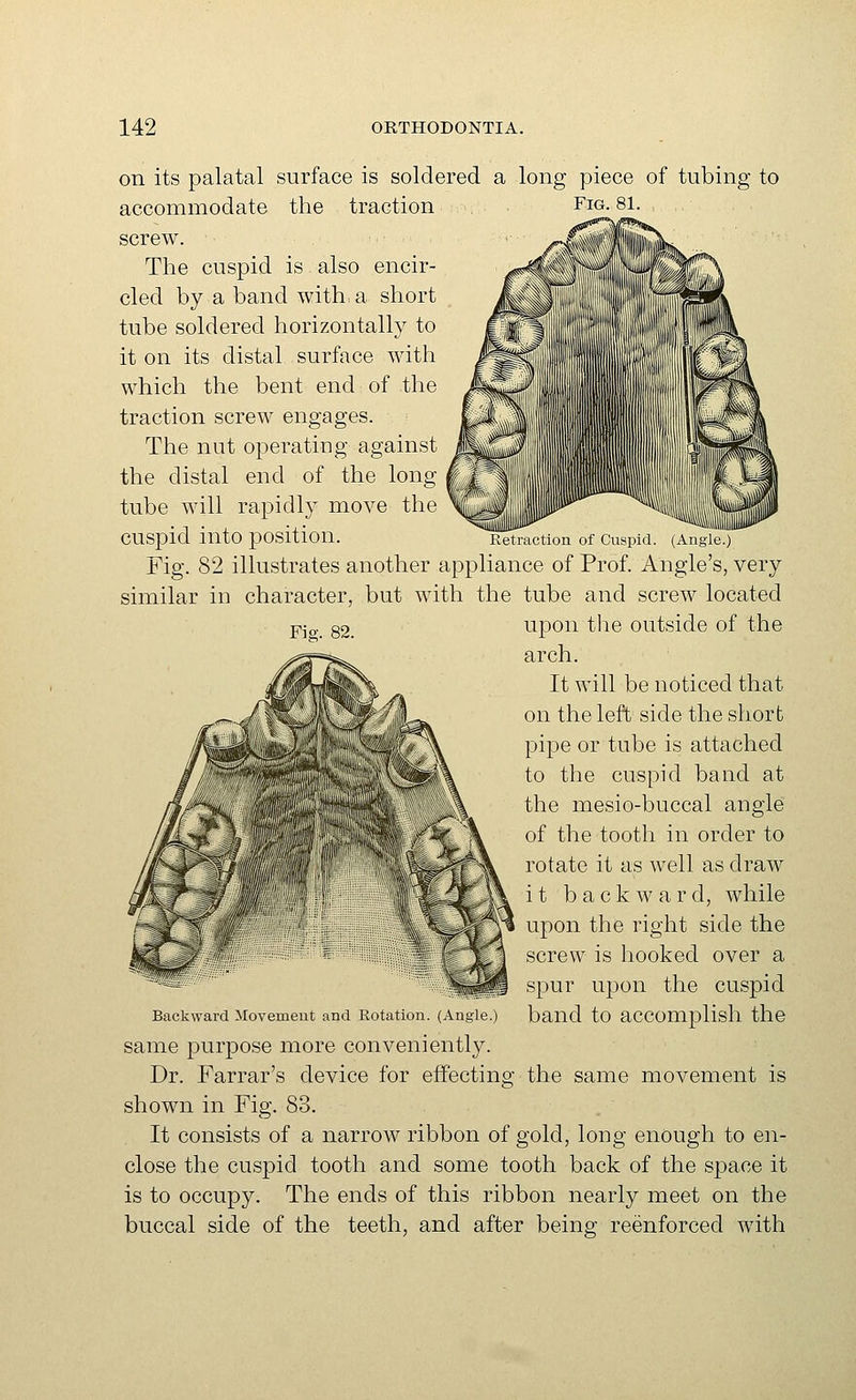 on its palatal surface is soldered a long piece of tubing to accommodate the traction Fig. 81. screw. The cuspid is also encir- cled by a band with a short tube soldered horizontally to it on its distal surface with which the bent end of the traction screw engages. The nut operating against the distal end of the long tube will rapidly move the cuspid into position. Retraction of Cuspid. (Angle.) Fig. 82 illustrates another appliance of Prof. Angle's, very similar in character, but with the tube and screw located jPjo._ 82. upon tlie outside of the arch. It will be noticed that on the left side the short pipe or tube is attached to the cuspid band at the mesio-buccal angle of the tooth in order to rotate it as well as draw it backward, while upon the right side the screw is hooked over a spur upon the cuspid Backward Movement and Rotation. (Angle.) band to accomplish the same purpose more conveniently. Dr. Farrar's device for effecting the same movement is shown in Fig. 83. It consists of a narrow ribbon of gold, long enough to en- close the cuspid tooth and some tooth back of the space it is to occupy. The ends of this ribbon nearly meet on the buccal side of the teeth, and after being reenforced with