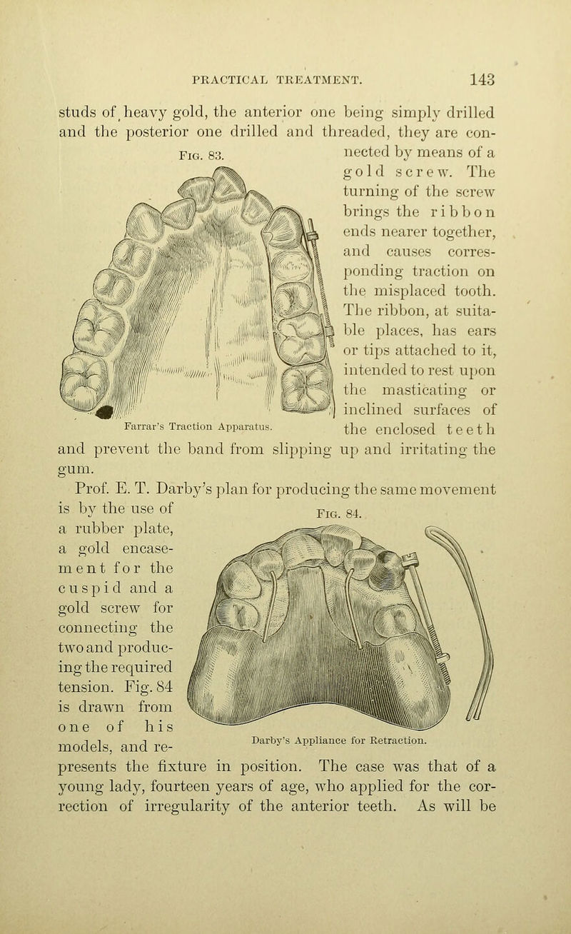 Fig. 83. studs of heavy gold, the anterior one being simply drilled and the posterior one drilled and threaded, they are con- nected by means of a gold screw. The turning of the screw brings the ribbon ends nearer together, and causes corres- ponding traction on the misplaced tooth. The ribbon, at suita- ble places, has ears or tips attached to it, intended to rest U})on the masticating or inclined surfaces of Fariai . Traction Appaiatus. the enclosed teeth and prevent the band from slipping up and irritating the gum. Prof. E. T. Darby's plan for producing the same movement is by the use of a rubber plate, a gold encase- ment for the cuspid and a gold screw for connecting the two and produc- ing the required tension. Fig. 84 is drawn from one of his models, and re- presents the fixture in position. The case was that of a young lady, fourteen years of age, who applied for the cor- rection of irregularity of the anterior teeth. As will be Fig. 84. Daiby's Appliance foi Retraction