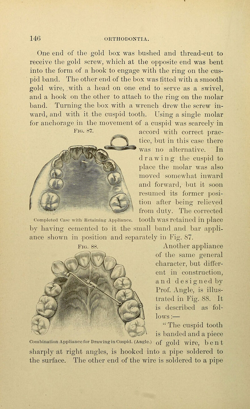 Fig. 87. One end of the gold box was bushed and thread-cut to receive the gold screw, which at the opposite end was bent into the form of a hook to engage with the ring on the cus- pid band. The other end of the box was fitted with a smooth gold wire, with a head on one end to serve as a swivel, and a hook on the other to attach to the ring on the molar band. Turning the box with a wrench drew the screw in- ward, and with it the cuspid tooth. Using a single molar for anchorage in the movement of a cuspid was scarcely in accord with correct prac- tice, but in this case there was no alternative. In d rawing the cuspid to place the molar was also moved somewhat inward and forward, but it soon resumed its former posi- tion after being relieved from duty. The corrected Completed Case with Retainiug Appliance, tootll WaS retained in place by having cemented to it the small band and bar appli- ance shown in position and separately in Fig. 87. Another appliance of the same general character, but differ- ent in construction, and d e s i g n e d by Prof. Angle, is illus- trated in Fig. 88. It is described as fol- lows :—  The cuspid tooth is banded and a piece Combination Appliance for Drawing m Cuspid (Angle.) Q-f o'old wirC bent sharply at right angles, is hooked into a pipe soldered to the surface. The other end of the wire is soldered to a pipe