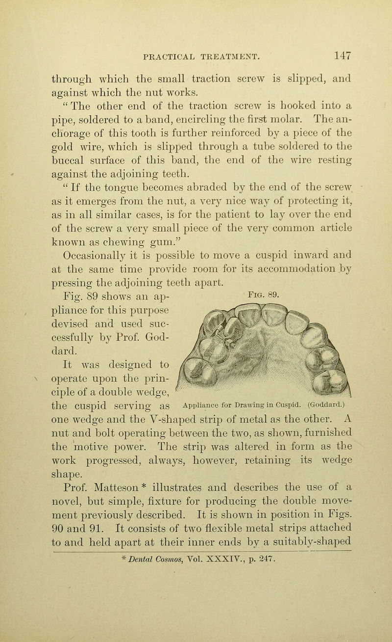 through which the small traction screw is slipped, and against which the nut works.  The other end of the traction screw is hooked into a pipe, soldered to a band, encircling the first molar. The an- chorage of this tooth is further reinforced by a piece of the gold wire, which is slipped through a tube soldered to the buccal surface of this band, the end of the wire resting against the adjoining teeth.  If the tongue becomes abraded by the end of the screw as it emerges from the nut, a very nice way of protecting it, as in all similar cases, is for the patient to lay over the end of the screw a very small piece of the very common article known as chewing gum. Occasionally it is possible to move a cuspid inward and at the same time provide room for its accommodation by pressing the adjoining teeth apart. Fig. 89 shows an ap- pliance for this purpose devised and used suc- cessfully by Prof. God- dard. It was designed to operate upon the prin- ciple of a double wedge, the cuspid serving as Appliance for Drawing in Cuspid. (Goddard.) one wedge and the V-shaped strip of metal as the other. A nut and bolt operating between the two, as shown, furnished the motive power. The strip was altered in form as the work progressed, always, however, retaining its wedge shape. Prof Matteson * illustrates and describes the use of a novel, but simple, fixture for producing the double move- ment previously described. It is shown in position in Figs. 90 and 91. It consists of two flexible metal strips attached to and held apart at their inner ends by a suitably-shaped