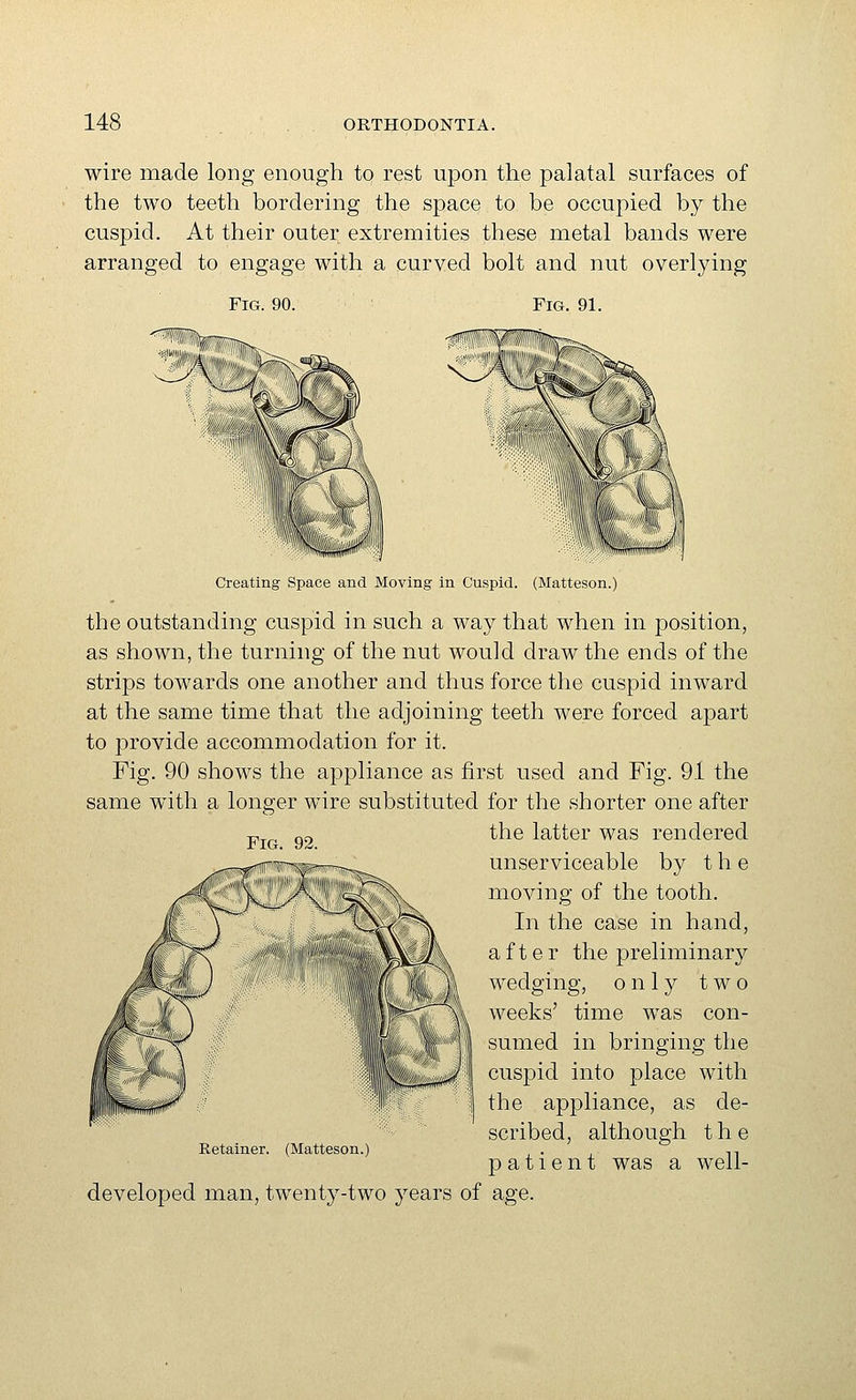 wire made long enough to rest upon the palatal surfaces of the two teeth bordering the space to be occupied by the cuspid. At their outer extremities these metal bands were arranged to engage with a curved bolt and nut overlying Fig. 90. Fig. 91. Fig, 92. Creating Space and Moving in Cuspid. (Matteson.) the outstanding cuspid in such a way that when in position, as shown, the turning of the nut would draw the ends of the strips towards one another and thus force the cuspid inward at the same time that the adjoining teeth were forced apart to provide accommodation for it. Fig. 90 shows the appliance as first used and Fig. 91 the same with a longer wire substituted for the shorter one after the latter was rendered unserviceable by the moving of the tooth. In the case in hand, after the preliminary wedging, only two weeks' time was con- sumed in bringing the cuspid into place with the appliance, as de- scribed, although the patient was a well- developed man, twenty-two years of age. Retainer. (Matteson.^