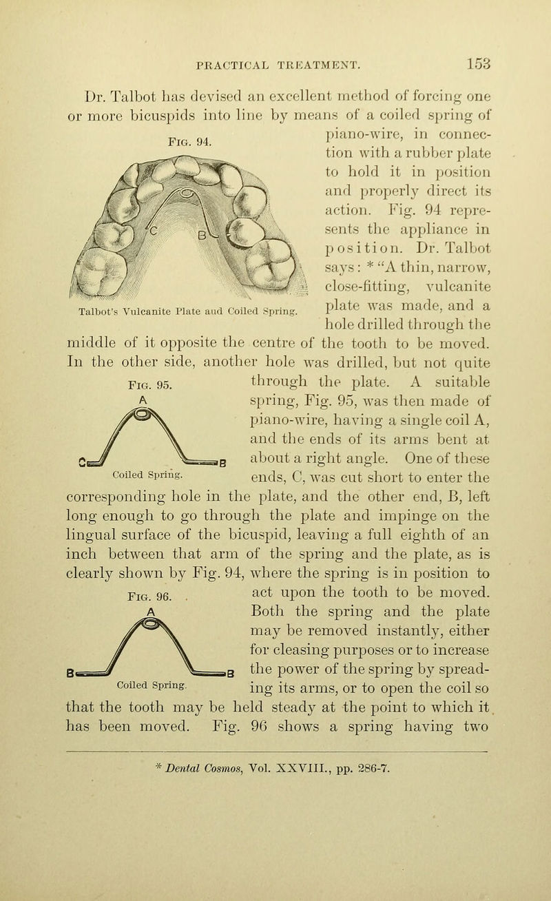 Fig. 94. Talbot s Vulcanite Plate and ( oiled spunt Fig. 95. Dr. Talbot lias devised an excellent method of forcing one or more bicuspids into line by means of a coiled spring of piano-wire, in connec- tion with a rubber plate to hold it in position and properly direct its action. Fig. 94 repre- sents the appliance in position. Dr. Talbot says: * A thin, narrow, close-fitting, vulcanite plate w^as made, and a hole drilled through the middle of it opposite the centre of the tooth to be moved. In the other side, another hole was drilled, but not quite through the plate. A suitaljle spring. Fig. 95, was then made of piano-wire, having a single coil A, and the ends of its arms bent at about a right angle. One of these ends, C, was cut short to enter the corresponding hole in the plate, and the other end, B, left long enough to go through the plate and impinge on the lingual surface of the bicuspid, leaving a full eighth of an inch between that arm of the spring and the plate, as is clearly shown by Fig. 94, where the spring is in position to act upon the tooth to be moved. Both the spring and the plate may be removed instantly, either for cleasing purposes or to increase the power of the spring by spread- ing its arms, or to open the coil so that the tooth may be held steady at the point to which it. has been moved. Fig. 96 shows a spring having two Coiled Spring. Fig. 96. A Coiled Spring.