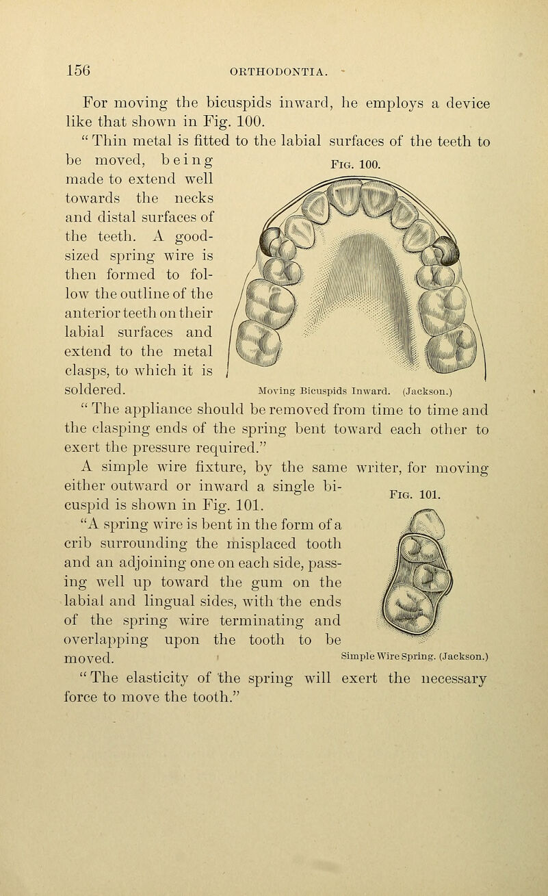 Fig. 100. For moving the bicuspids inward, he employs a device like that shown in Fig. 100.  Thin metal is fitted to the labial surfaces of the teeth to be moved, being made to extend well towards the necks and distal surfaces of the teeth. A good- sized spring wire is then formed to fol- low the outline of the anterior teeth on their labial surfaces and extend to the metal clasps, to which it is soldered. Moving Bicuspids Inward. (Jackson.)  The appliance should be removed from time to time and the clasping ends of the spring bent toward each other to exert the pressure required. A simple wire fixture, by the same writer, for moving either outward or inward a single bi- cuspid is shown in Fig. 101. A spring wire is bent in the form of a crib surrounding the misplaced tooth and an adjoining one on each side, pass- ing well up toward the gum on the labial and lingual sides, with the ends of the spring wire terminating and overlapping upon the tooth to be moved. simple wire Spnng (Jackson.)  The elasticity of 'the spring will exert the necessary force to move the tooth.