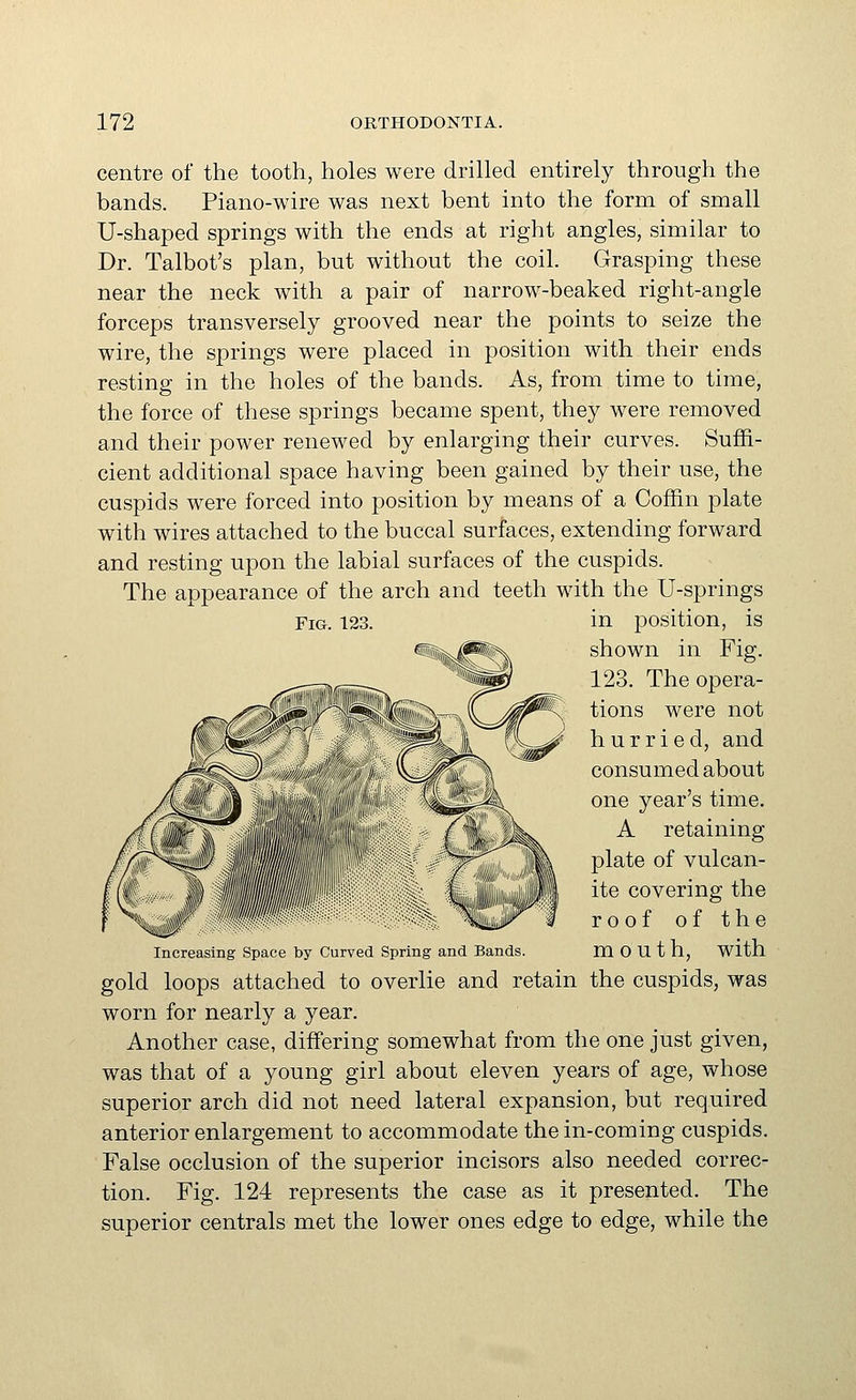 centre of the tooth, holes were drilled entirely through the bands. Piano-wire was next bent into the form of small U-shaped springs with the ends at right angles, similar to Dr. Talbot's plan, but without the coil. Grasping these near the neck with a pair of narrow-beaked right-angle forceps transversely grooved near the points to seize the wire, the springs were placed in position with their ends resting in the holes of the bands. As, from time to time, the force of these springs became spent, they were removed and their power renewed by enlarging their curves. Suffi- cient additional space having been gained by their use, the cuspids were forced into position by means of a Coffin plate with wires attached to the buccal surfaces, extending forward and resting upon the labial surfaces of the cuspids. The appearance of the arch and teeth with the U-springs Fig. 123. in position, is shown in Fig. 123. The opera- tions were not hurried, and consumed about one year's time. A retaining plate of vulcan- ite covering the roof of the Increasing Space t>y Curved Spring and Bands m 0 U t h. With gold loops attached to overlie and retain the cuspids, was worn for nearly a year. Another case, differing somewhat from the one just given, was that of a young girl about eleven years of age, whose superior arch did not need lateral expansion, but required anterior enlargement to accommodate the in-coming cuspids. False occlusion of the superior incisors also needed correc- tion. Fig. 124 represents the case as it presented. The superior centrals met the lower ones edge to edge, while the