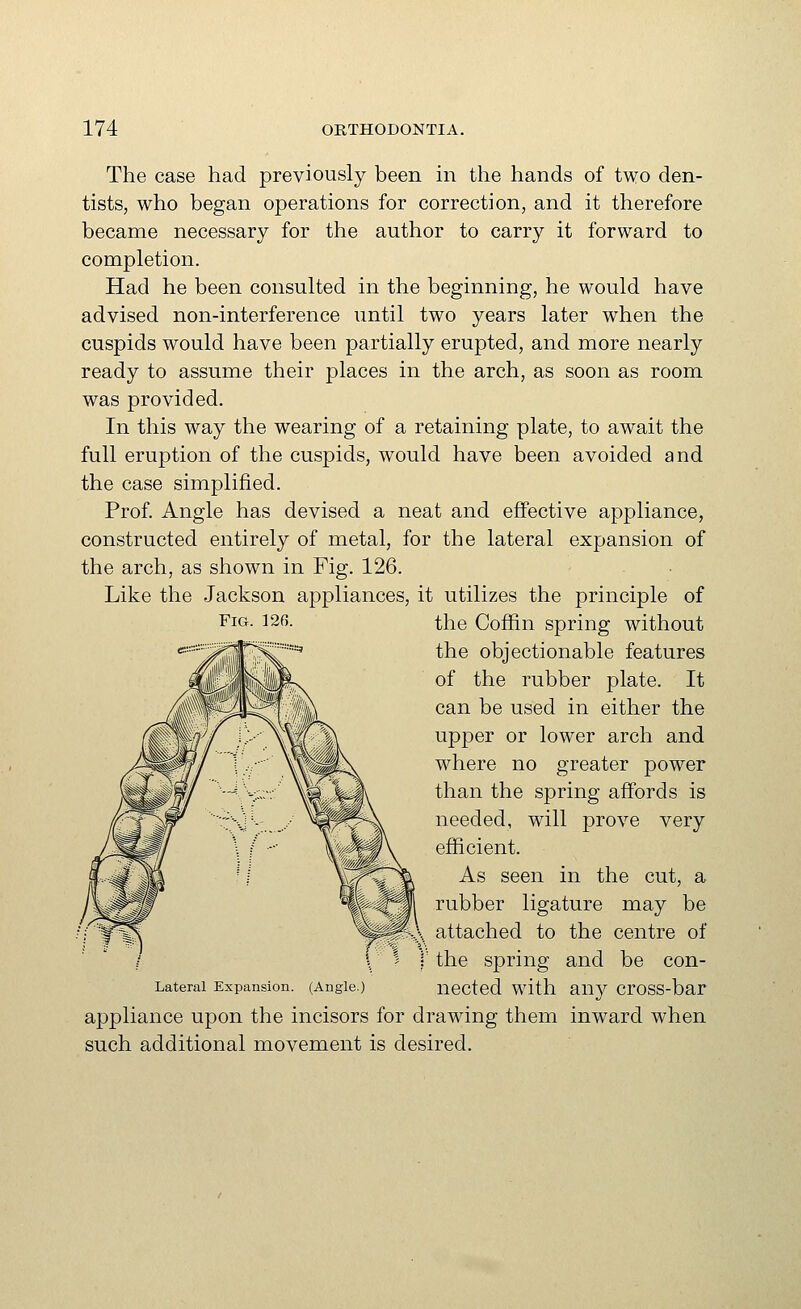 The case had previously been in the hands of two den- tists, who began operations for correction, and it therefore became necessary for the author to carry it forward to completion. Had he been consulted in the beginning, he would have advised non-interference until two years later when the cuspids would have been partially erupted, and more nearly ready to assume their places in the arch, as soon as room was provided. In this way the wearing of a retaining plate, to await the full eruption of the cuspids, would have been avoided and the case simplified. Prof. Angle has devised a neat and effective appliance, constructed entirely of metal, for the lateral expansion of the arch, as shown in Fig. 126. Like the Jackson appliances, it utilizes the principle of the Coffin spring without the objectionable features of the rubber plate. It can be used in either the upper or lower arch and where no greater power than the spring affords is needed, will prove very efficient. As seen in the cut, a rubber ligature may be attached to the centre of the spring and be con- Laterai Expansion. (Angle) nected with any cross-bar appliance upon the incisors for drawing them inward when such additional movement is desired. Fig. 126.