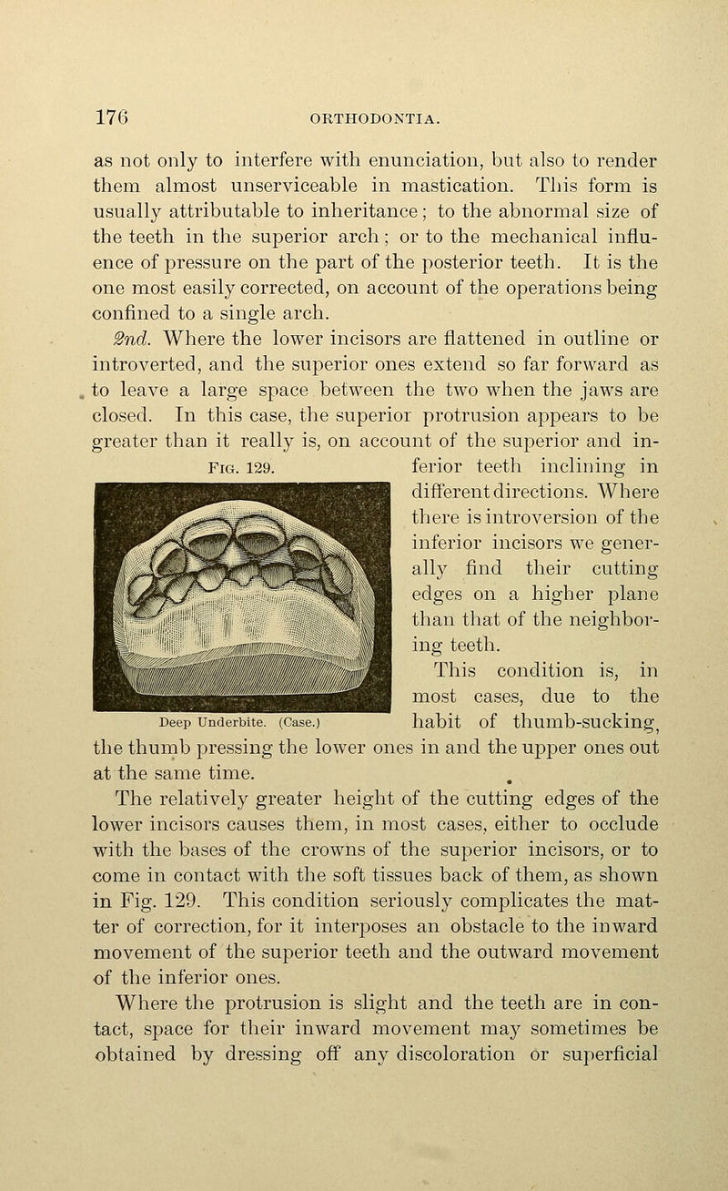 as not only to interfere with enunciation, but also to render them almost unserviceable in mastication. This form is usually attributable to inheritance; to the abnormal size of the teeth in the superior arch; or to the mechanical influ- ence of pressure on the part of the posterior teeth. It is the one most easily corrected, on account of the operations being confined to a single arch. Snd. Where the lower incisors are flattened in outline or introverted, and the superior ones extend so far forward as to leave a large space between the two when the jaws are closed. In this case, the superior protrusion appears to be greater than it really is, on account of the superior and in- FiG. 129. ferior teeth inclining in different directions. Where there is introversion of the inferior incisors we gener- ally find their cutting edges on a higher plane than that of the neighbor- ing teeth. This condition is, in most cases, due to the Deep Underbite. (Case.) habit of thumb-SUcking, the thumb pressing the lower ones in and the upper ones out at the same time. The relatively greater height of the cutting edges of the lower incisors causes them, in most cases, either to occlude with the bases of the crowns of the superior incisors, or to come in contact with the soft tissues back of them, as shown in Fig. 129. This condition seriously complicates the mat- ter of correction, for it interposes an obstacle to the inward movement of the superior teeth and the outward movement of the inferior ones. Where the protrusion is slight and the teeth are in con- tact, space for their inward movement may sometimes be obtained by dressing off any discoloration or superficial