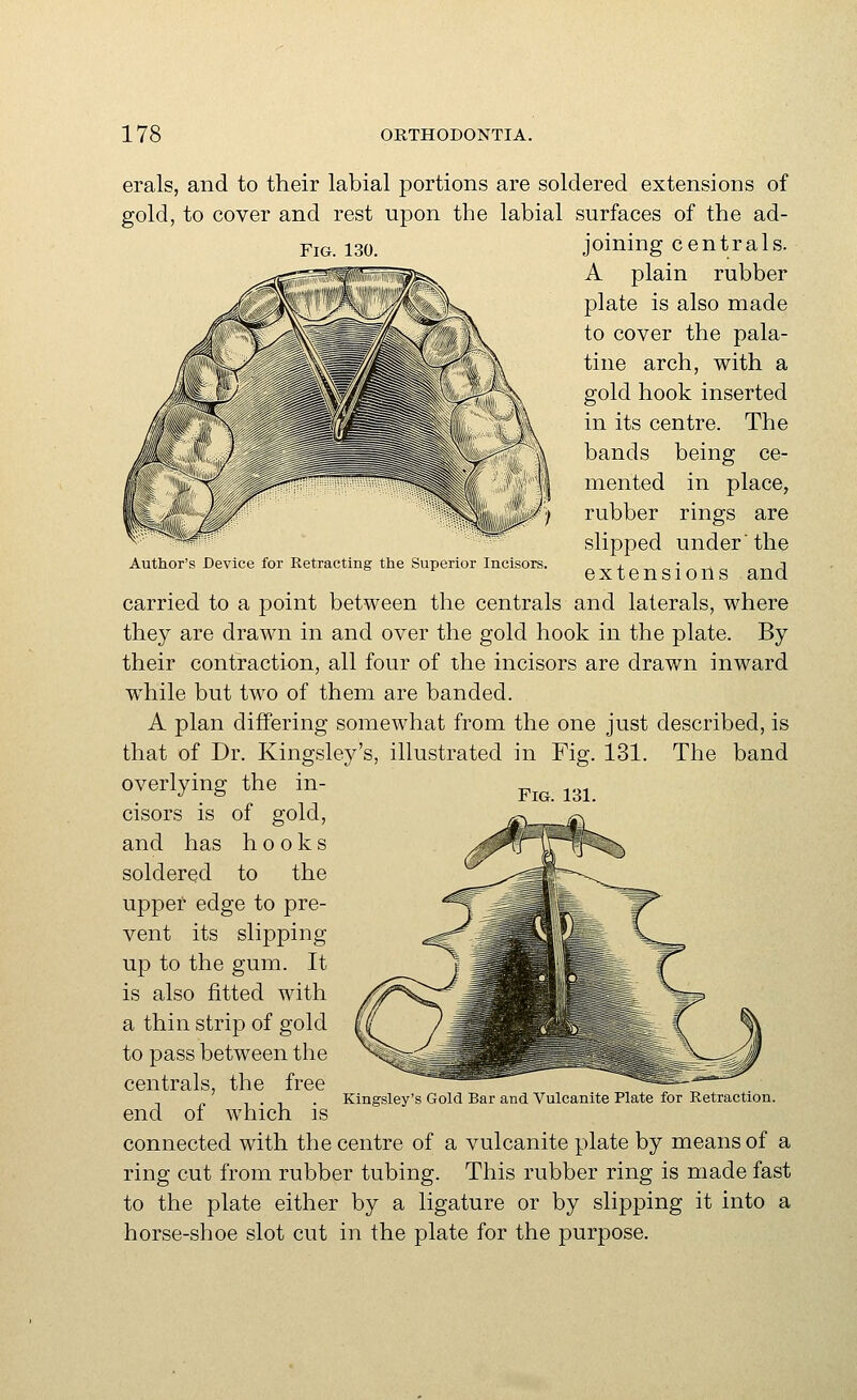 Fig. 130. erals, and to their labial portions are soldered extensions of gold, to cover and rest upon the labial surfaces of the ad- joining centrals. A plain rubber plate is also made to cover the pala- tine arch, with a gold hook inserted in its centre. The bands being ce- mented in place, rubber rings are slipped under'the extensions and carried to a point between the centrals and laterals, where they are drawn in and over the gold hook in the plate. By their contraction, all four of the incisors are drawn inward while but two of them are banded. A plan differing somewhat from the one just described, is that of Dr. Kingsley's, illustrated in Fig. 131. The band overlying the in- Author's Device for Retracting the Superior Incisors. Fig. 131. cisors is of gold, and has hooks soldered to the upper edge to pre- vent its slipping up to the gum. It is also fitted with a thin strip of gold to pass between the centrals, the free end of which is connected with the centre of a vulcanite plate by means of a ring cut from rubber tubing. This rubber ring is made fast to the plate either by a ligature or by slipping it into a horse-shoe slot cut in the plate for the purpose. Kingsley's Gold Bar and Vulcanite Plate for Retraction.