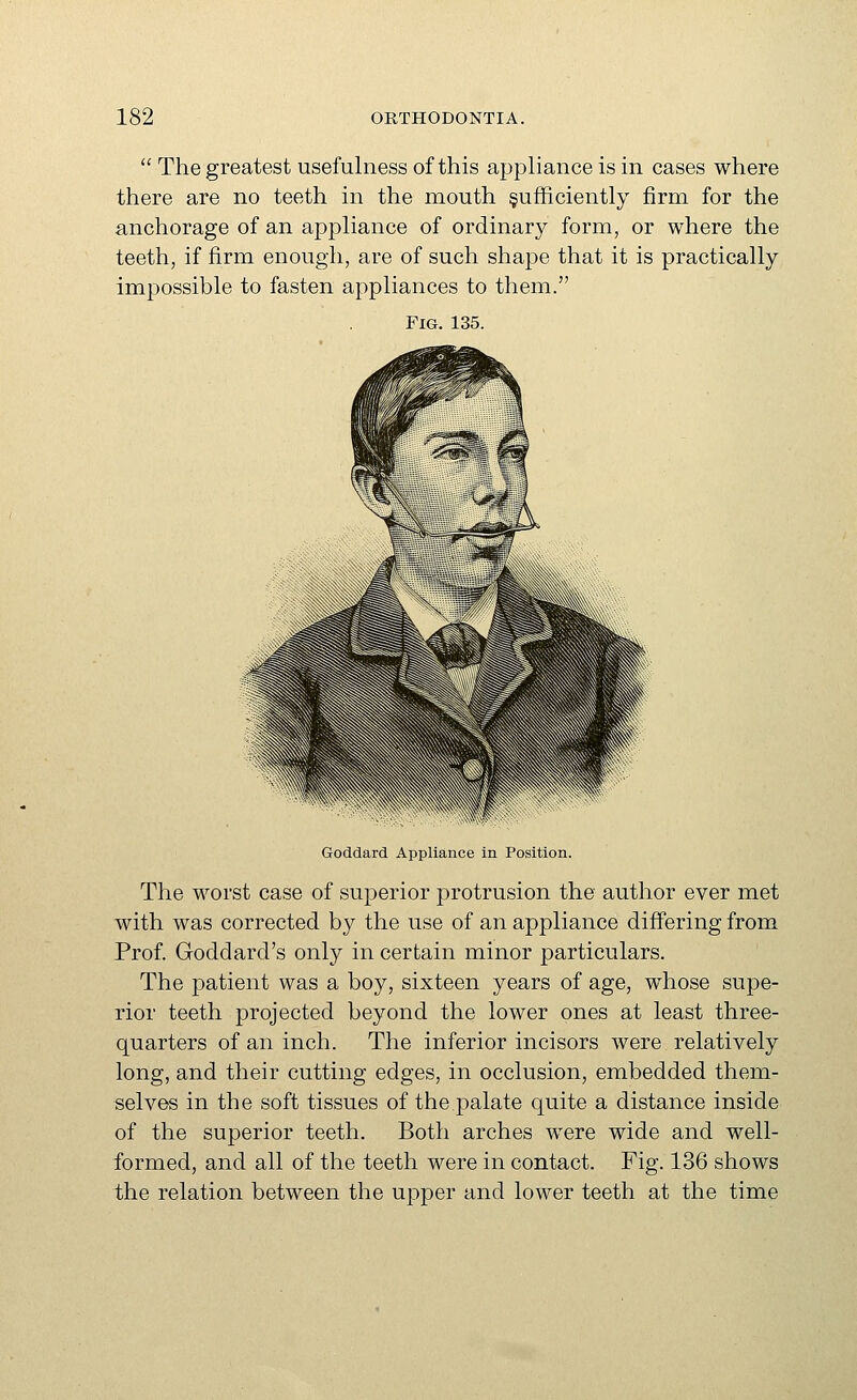  The greatest usefulness of this appliance is in cases where there are no teeth in the mouth §ufficiently firm for the anchorage of an appliance of ordinary form, or where the teeth, if firm enough, are of such shape that it is practically impossible to fasten appliances to them. Fig. 135. Goddard Appliance in Position. The worst case of superior protrusion the author ever met with was corrected by the use of an appliance diff'ering from Prof. Goddard's only in certain minor particulars. The patient was a boy, sixteen years of age, whose supe- rior teeth projected beyond the lower ones at least three- quarters of an inch. The inferior incisors were relatively long, and their cutting edges, in occlusion, embedded them- selves in the soft tissues of the palate quite a distance inside of the superior teeth. Both arches were wide and well- formed, and all of the teeth were in contact. Fig. 136 shows the relation between the upper and lower teeth at the time