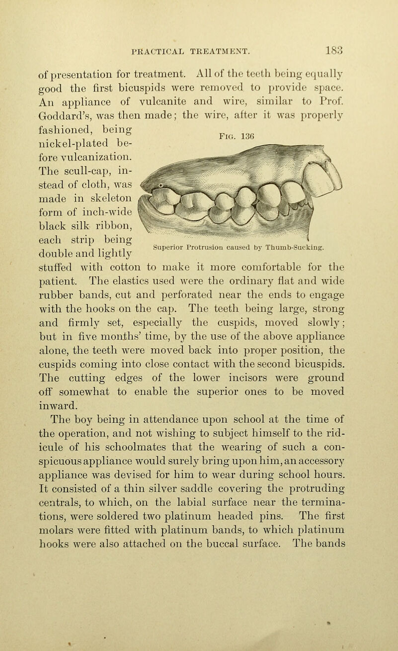 Superior Protrusion caused by Thumb-Sucking. of presentation for treatment. All of the teeth being equally good the first bicuspids were removed to provide space. An appliance of vulcanite and wire, similar to Prof. Goddard's, was then made; the wire, after it was properly fashioned, being ^^^^^^ nickel-plated be- fore vulcanization. The scull-cap, in- stead of cloth, was made in skeleton form of inch-wide black silk ribbon, each strip being double and lightly stuffed with cotton to make it more comfortable for the patient. The elastics used M^ere the ordinary flat and wide rubber bands, cut and perforated near the ends to engage with the hooks on the cap. The teeth being large, strong and firmly set, especially the cuspids, moved slowly; but in five months' time, by the use of the above appliance alone, the teeth were moved back into proper position, the cuspids coming into close contact with the second bicuspids. The cutting edges of the lower incisors were ground off somewhat to enable the superior ones to be moved inward. The boy being in attendance upon school at the time of the operation, and not wishing to subject himself to the rid- icule of his schoolmates that the wearing of such a con- spicuous appliance would surely bring upon him, an accessory appliance was devised for him to wear during school hours. It consisted of a thin silver saddle covering the protruding centrals, to which, on the labial surface near the termina- tions, were soldered two platinum headed pins. The first molars were fitted with platinum bands, to which platinum hooks were also attached on the buccal surface. The bands