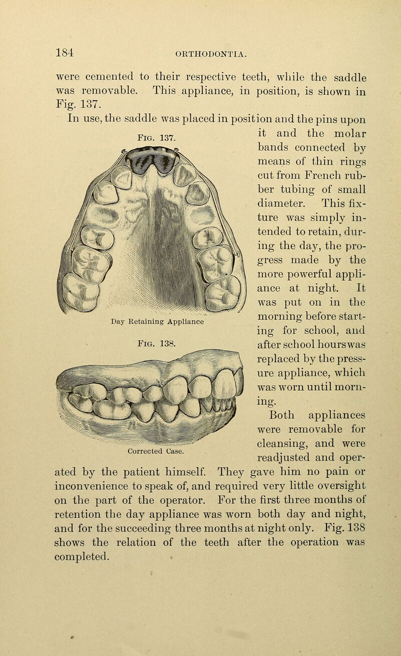 were was Fig. In Fig. 137. cemented to their respective teeth, while the saddle removable. This appliance, in position, is shown in 137. use, the saddle was placed in position and the pins upon it and the molar bands connected by means of thin rings cut from French rub- ber tubing of small diameter. This fix- ture was simply in- tended to retain, dur- ing the day, the pro- gress made by the more powerful appli- ance at night. It was put on in the morning before start- ing for school, and after school hours was replaced by the press- ure appliance, which was worn until morn- Day Retaining Appliance Fig. 138. Corrected Case. mg. Both appliances were removable for cleansing, and were readjusted and oper- ated by the patient himself. They gave him no pain or inconvenience to speak of, and required very little oversight on the part of the operator. For the first three months of retention the day appliance was worn both day and night, and for the succeeding three months at night only. Fig. 138 shows the relation of the teeth after the operation was completed. •