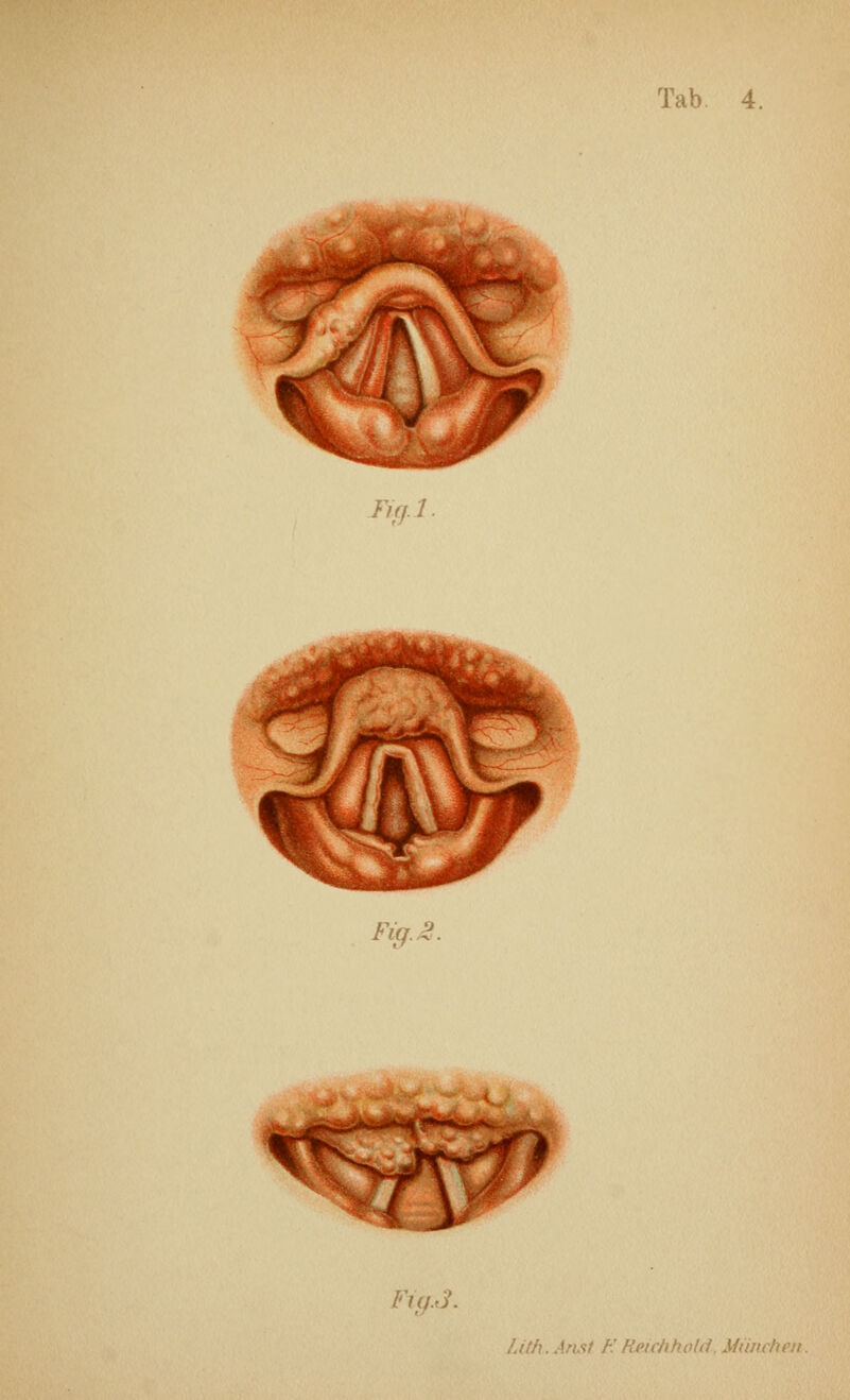 iifjl Fig. ^ FigJ. Lith. Anst F. Reichkold, Miinchen.