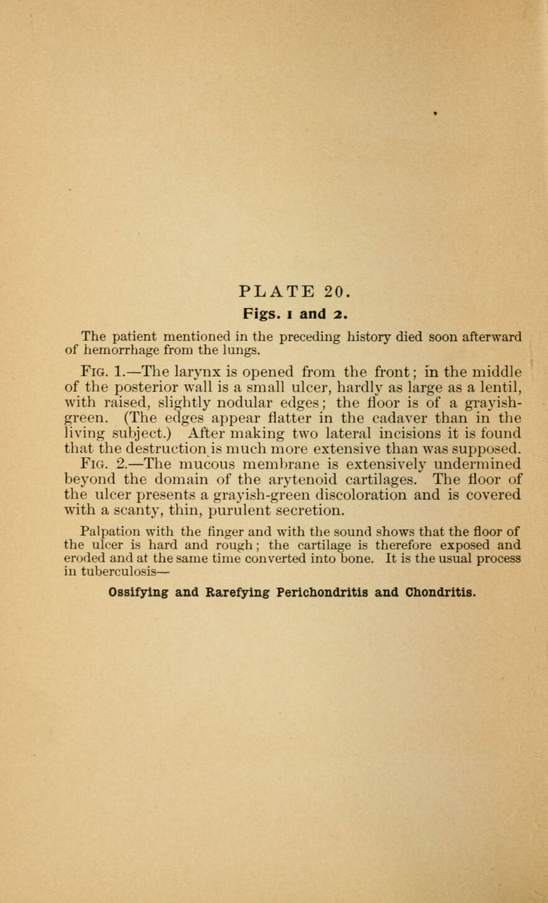 PLATE 20. Figs. I and 2. The patient mentioned in the preceding history died soon afterward of hemorrhage from the lungs. Fig. 1.—The larynx is opened from the front; in the middle of the posterior wall is a small ulcer, hardly as large as a lentil, with raised, slightly nodular edges; the floor is of a grayish- green. (The edges appear flatter in the cadaver than in the living subject.) After making two lateral incisions it is found that the destruction is much more extensive than was supposed. Fig. 2.—The mucous membrane is extensively undermined beyond the domain of the arytenoid cartilages. The floor of the ulcer presents a grayish-green discoloration and is covered with a scanty, thin, purulent secretion. Palpation with the finger and with the sound shows that the floor of the ulcer is hard and rough; the cartilage is therefore exposed and eroded and at tlie same time converted into bone. It is the usual process in tuberculosis— Ossifying and Rarefying Fericliondritis and Chondritis.