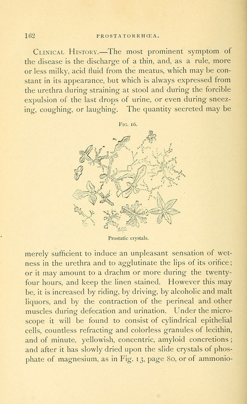 Clinical History.—The most prominent symptom of the disease is the discharge of a thin, and, as a rule, more or less milky, acid fluid from the meatus, which may be con- stant in its appearance, but which is always expressed from the urethra during straining at stool and during the forcible expulsion of the last drops of urine, or even during sneez- ing, coughing, or laughing. The quantity secreted may be Fig. i6. Prostatic crystals. merely sufficient to induce an unpleasant sensation of wet- ness in the urethra and to agglutinate the lips of its orifice; or it may amount to a drachm or more during the twenty- four hours, and keep the linen stained. However this may be, it is increased by riding, by driving, by alcoholic and malt liquors, and by the contraction of the perineal and other muscles during defecation and urination. Under the micro- scope it will be found to consist of cylindrical epithelial cells, countless refracting and colorless granules of lecithin, and of minute, yellowish, concentric, amyloid concretions ; and after it has slowly dried upon the slide crystals of phos- phate of magnesium, as in Fig. 13, page 80, or of ammonio-