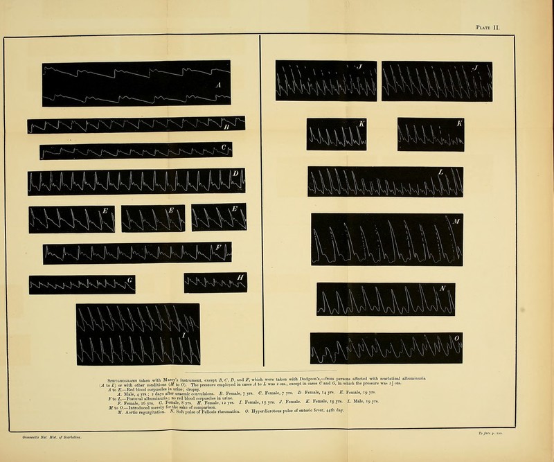 I taken with Budg Spbtgmograms taken with Marey's inBtrument, except B, C, D, and F, which v : to i) or with other conditions {M to 0). The pressure employed in cases A io L A to E.—Red blood corpuscles in urine; dropsy. A. Male, 4 yra.; 2 days after uraemic convulsions. jFto i.—Postural albuminuria; no red blood corpuHclea , „ , — -r, •> t ht 1 i?. Female, 16 yra. G. Female, 8 yrs. H. Female, 12 yrs. J. Female, 15 yrs. /.Female. £: Female, 15 yra. L. Mtde, 19 yv, M to 6.—Introduced merely for the sake of comparison. c ^ • c *t, .1 M. Aortic regurgitation. ^. Soft pulse of Peliosis rheumatica. 0. Hyperdicrotoue pulae of entenc fever, 44th day. affected with scarlatinal albun: h the pressure wa-s 2k ozs. Female, 7 yre. C. Female, 7 yr3. Z>. Female, 14 yra. E. Female, 19 yra. , Hilt, of Scarlatina.