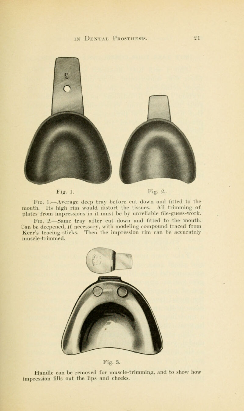 Fig. 1. Fis Fig. 1.—Average deep tray before eiit down and fitted to the mouth. Its high rim would distort tlie tissues. All trimming of plates from impressions in it must l)e In' unreliable file-guess-work. Fig. 2.—Same tray after cut down and fitted to the mouth. Can be deepened, if necessary, witli modeling compound traced from Kerr's tracing-sticks. Then the impression rim can be accurately muscle-trimmed. Fig. 3. Handle can be removed for nuiscle-trimminf impression fills out the lips and cheeks. and to show how