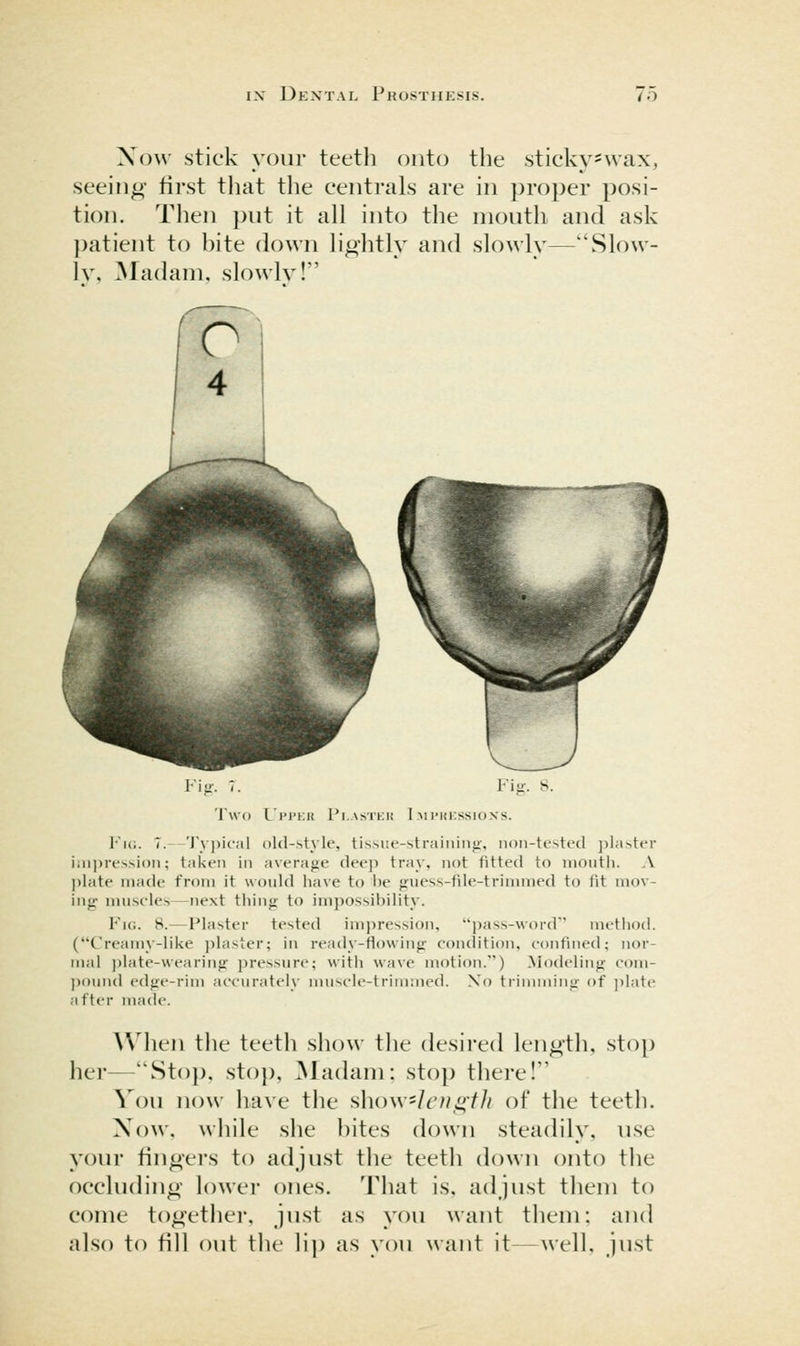 Now stick your teetli onto the stickv'vvax, seeing- first that the centrals are in proper posi- tion. Then j^ut it all into the mouth and ask patient to bite down lightly and slowly—Slow- ly, ^ladam, slowly! Fic. 7.—'J'y))ic'al <)ld-st_\ie, tissue-straining, non-tested jiiaster impression; taken in average deep tray, not fitted to nioutii. A |)late made from it would iiave to i)e guess-file-trinimed to fit mov- ing muscles—next thing to impossibility. Fig. 8.—Plaster tested imjiression, })ass-word method. (Creamy-like plaster; in ready-flowing condition, confined; nor- mal ))late-wearing pressure; with wave motion.) Modeling com- pound edge-rim accurately muscle-trimmed. Xo trinuniiig of ])late a fter made. AVhen the teeth show the desired length, stop her—Sto}), sto}), Madam: stop thei-el Vou now have the show-I eni^ih of the teeth. Now, while she bites down steadily, use your fingers to adjust the teeth down onto the occluding lower ones. That is, adjust them to come togethei, just as you want them: and also to fill out the lij) as you want it—well, just