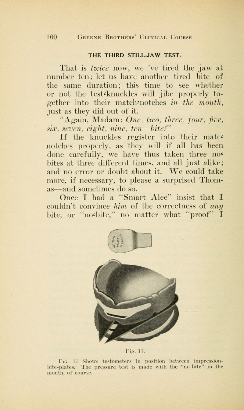 THE THIRD STILL=JAW TEST. That is ticicc now, we \e tired the jaAV at number ten; let us have another tired bite of the same duration; this time to see whether or not the test=knuckles will jibe properly to- gether into their match=notches in the mouthy just as they did out of it. Again, Madam: One, two, three, four, five, sia\ seven, eight, nine, ten—bite! If the knuckles register into their mate- notches properly, as they will if all has been done carefully, we have thus taken three no* bites at three different times, and all just alike; and no error or doubt about it. We could take more, if necessary, to please a surprised Thom- as—and sometimes do so. Once I had a Smart Alec insist that I couldn't convince hi?n of the correctness of cuu/ bite, or no*bite, no matter what proof I Fig. IT. Fig. 17 Shows testometers in position between impression- bite-plates. The pressure test is made with the no-bite in the mouth, of course.