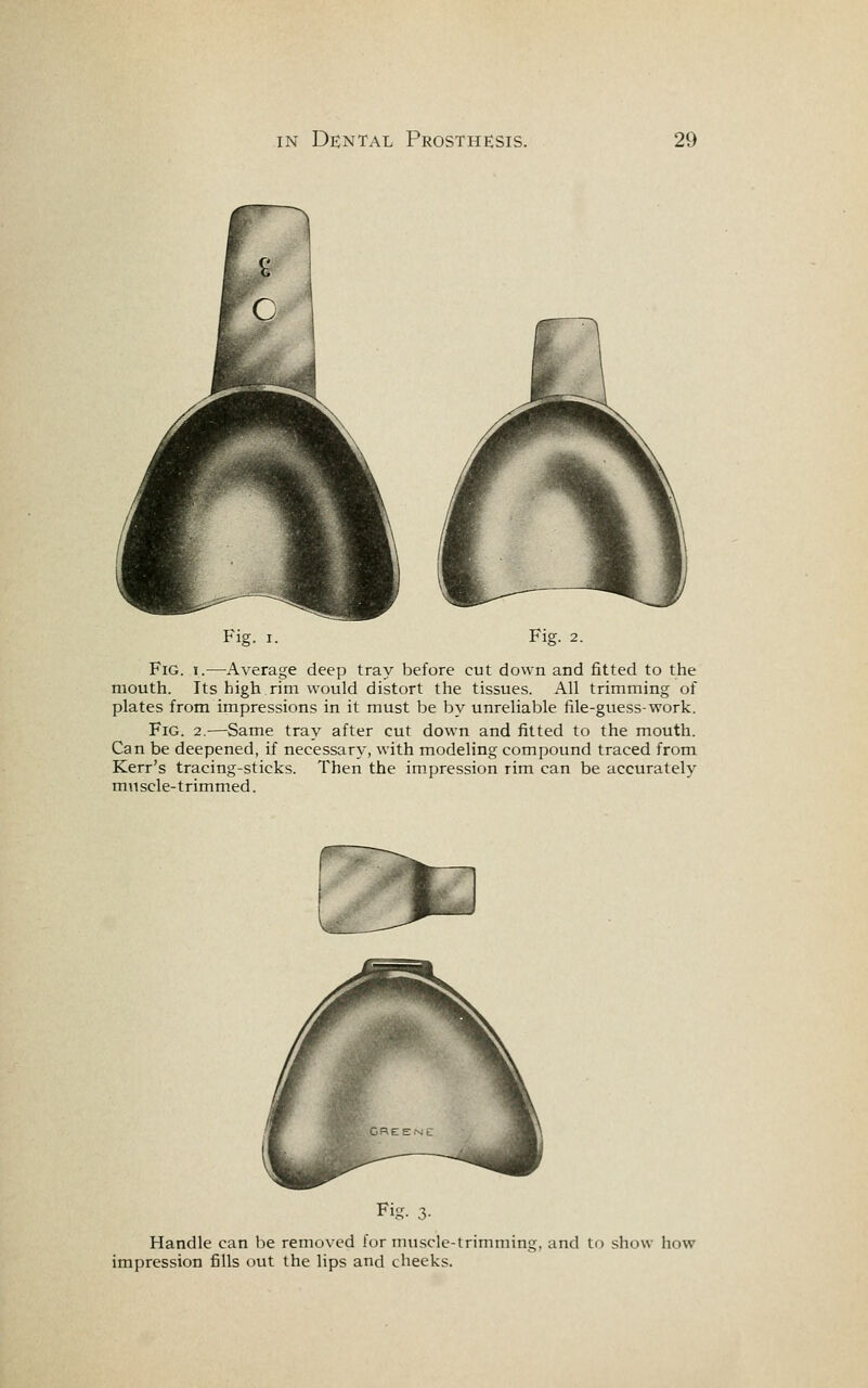 Fig. I.—Average deep tray before cut down and fitted to the mouth. Its high rim would distort the tissues. All trimming of plates from impressions in it must be by unreliable file-guess-work. Fig. 2.—Same tray after cut down and fitted to the mouth. Can be deepened, if necessary, with modeling compound traced from Kerr's tracing-sticks. Then the impression rim can be accurately muscle-trimmed. Handle can be removed for muscle-trimming, and li impression fills out the lips and cheeks. show how