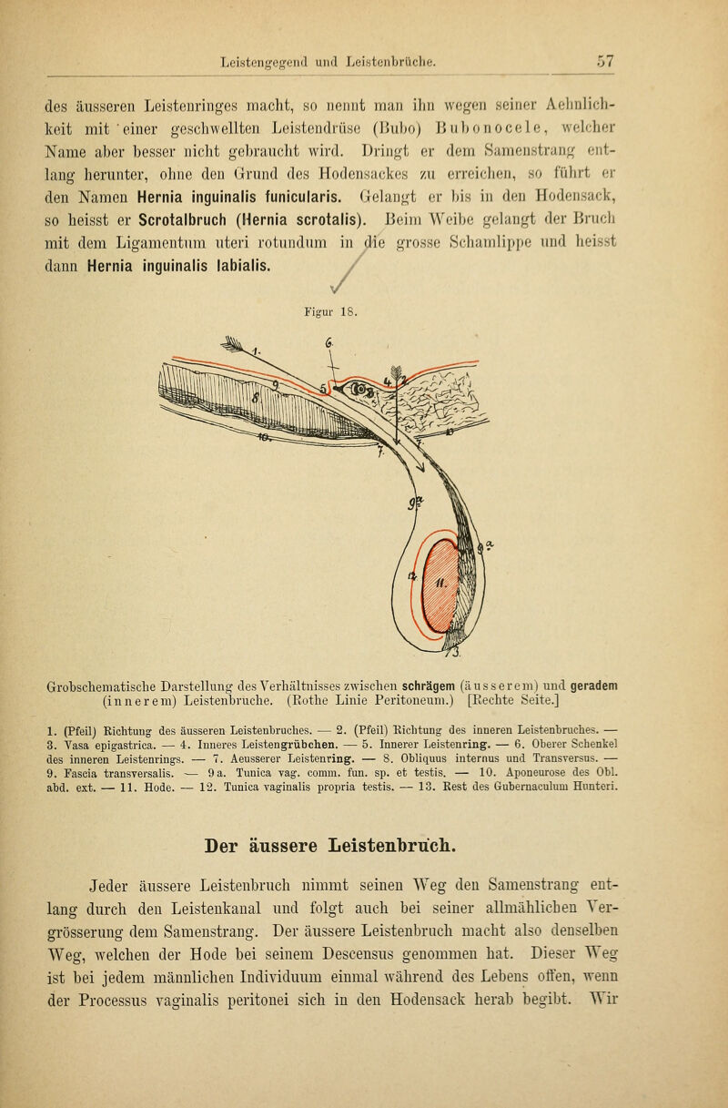 des äusseren Leistenringes macht, so nennt mun lim wegen seiner Aelinlicli- keit mit'einer geschwellten Leistendrüse (Jiubo) Jiuhonocele, welcher Name aber besser nicht gebraucht wird. Dringt er dem .Samenstrang ent- lang herunter, ohne den Grund des Hodensackes zu erreichen, ho führt er den Namen Hernia inguinalis funicularis. Gelangt er bis in den Hodensack, so heisst er Scrotalbruch (Hernia scrotalis). Beim Weibe gelangt der Brucli mit dem Ligamentum uteri rotundum in ^ie grosse Schamlippe und heisst dann Hernia inguinalis labialis. Figur 18. Grobscliematisclie Darstellung des Verhältnisses zwischen schrägem (äusserem) und geradem (innerem) Leistenbruche. (Rothe Linie Peritoneum.) [Rechte Seite.] 1. (Pfeil) Richtung des äusseren Leistenbruches. — 2. (Pfeil) Richtung des inneren Leistenbruches. — 3. Vasa epigastrica. — 4. Inneres Leistengrübchen. — 5. Innerer Leistenring. — 6. Oberer Schenkel des inneren Leistenrings. — 7. Aeusserer Leistenring. — 8. Obliquus internus und Transversus. — 9. Fascia transversalis. — 9 a. Tuuica vag. comm. fun. sp. et testis. — 10. Aponeurose des Obl. abd. ext. — 11. Hode. — 12. Tunica vaginalis propria testis. — 13. Rest des Gubernaculum Hunteri. Der äussere Leistenbruch. Jeder äussere Leistenbruch nimmt seinen Weg den Samenstrang ent- lang durch den Leistenkanal und folgt auch bei seiner allmählichen Ver- grösserung dem Samenstrang. Der äussere Leistenbruch macht also denselben Weg, welchen der Hode bei seinem Descensus genommen hat. Dieser Weg ist bei jedem männlichen Individuum einmal während des Lebens offen, wenn der Processus vaginalis peritonei sich in den Hodensack herab begibt. Wir