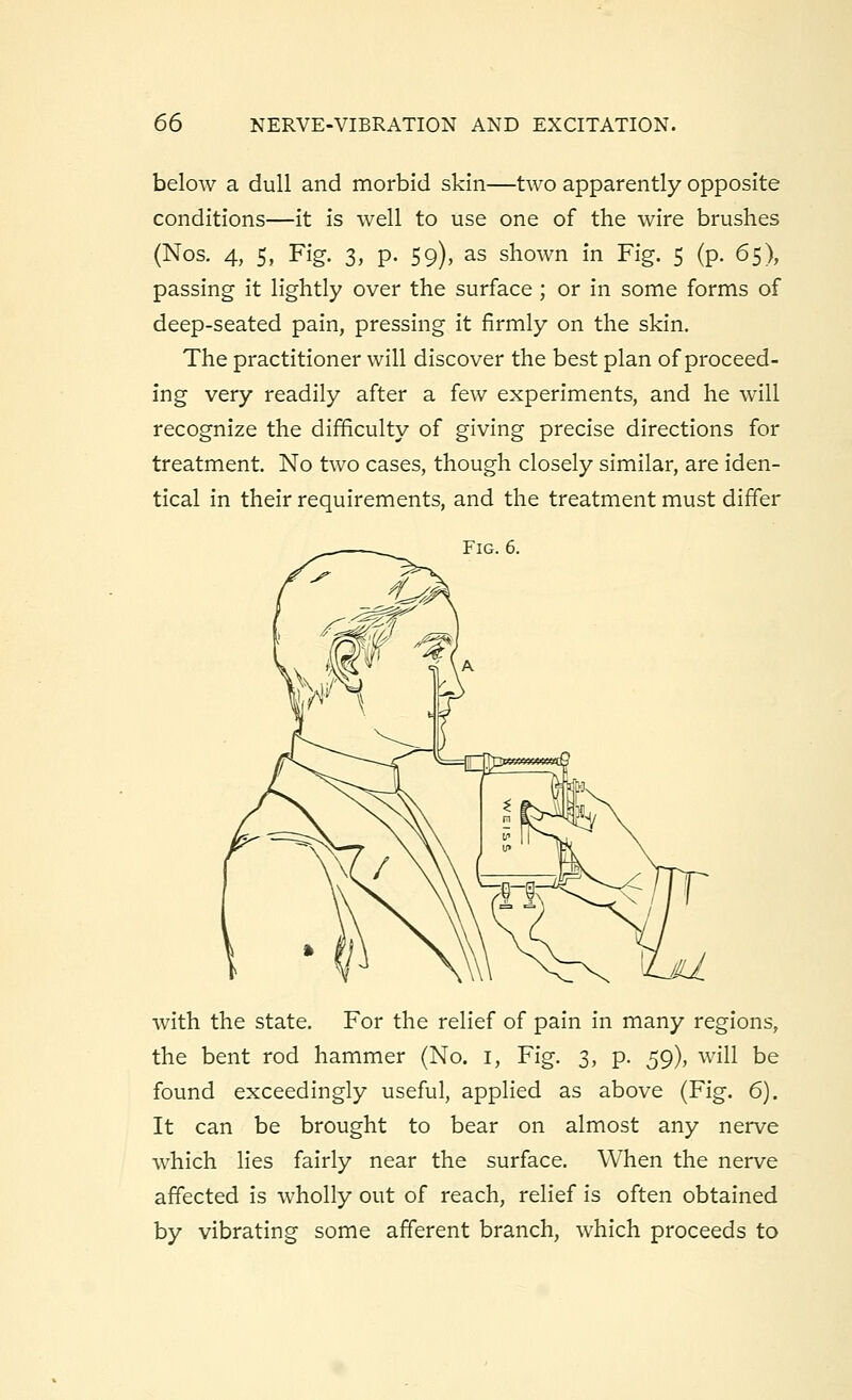 below a dull and morbid skin—two apparently opposite conditions—it is well to use one of the wire brushes (Nos. 4, 5, Fig. 3, p. 59), as shown in Fig. 5 (p. 65), passing it lightly over the surface ; or in some forms of deep-seated pain, pressing it firmly on the skin. The practitioner will discover the best plan of proceed- ing very readily after a few experiments, and he will recognize the difficulty of giving precise directions for treatment. No two cases, though closely similar, are iden- tical in their requirements, and the treatment must differ Fig. 6. with the state. For the relief of pain in many regions, the bent rod hammer (No. 1, Fig. 3, p. 59), will be found exceedingly useful, applied as above (Fig. 6). It can be brought to bear on almost any nerve which lies fairly near the surface. When the nerve affected is wholly out of reach, relief is often obtained by vibrating some afferent branch, which proceeds to
