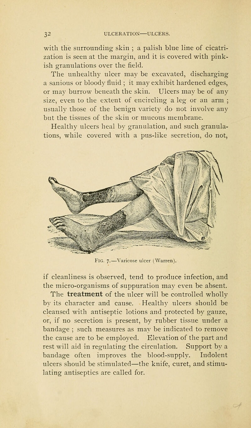 with the surrounding skin ; a palish blue line of cicatri- zation is seen at the margin, and it is covered with pink- ish granulations over the field. The unhealthy ulcer may be excavated, discharging a sanious or bloody fluid ; it may exhibit hardened edges, or may burrow beneath the skin. Ulcers may be of any size, even to the extent of encircling a leg or an arm ; usually those of the benign variety do not involve any but the tissues of the skin or mucous membrane. Healthy ulcers heal by granulation, and such granula- tions, while covered with a pus-like secretion, do not, Fig. 7.—Varicose ulcer (Warren). if cleanliness is observed, tend to produce infection, and the micro-organisms of suppuration may even be absent. The treatment of the ulcer will be controlled wholly by its character and cause. Health}^ ulcers should be cleansed with antiseptic lotions and protected by gauze, or, if no secretion is present, by rubber tissue under a bandage ; such measures as may be indicated to remove the cause are to be employed. Elevation of the part and rest will aid in regulating the circulation. Support by a bandage often improves the blood-supply. Indolent ulcers should be stimulated—the knife, curet, and stimu- lating antiseptics are called for.