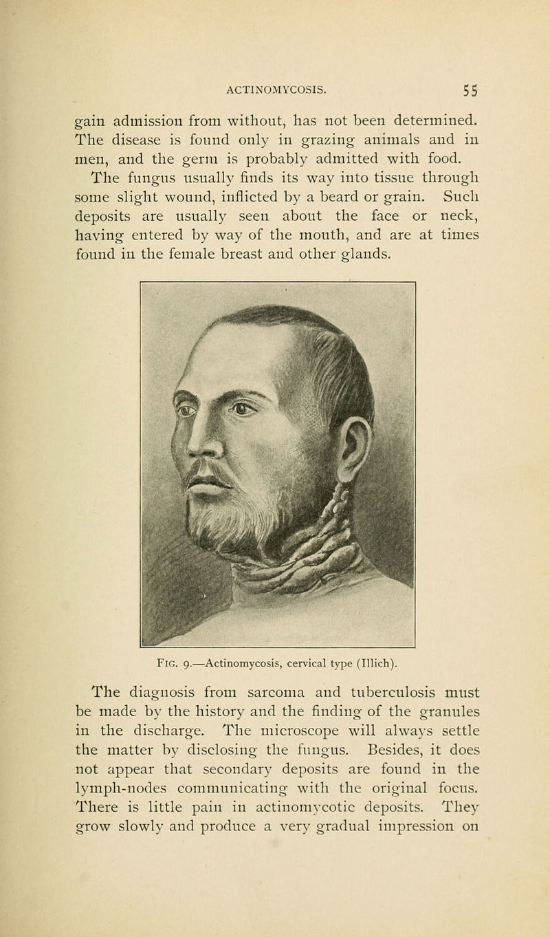 gain admission from without, has not been determined. The disease is found only in grazing animals and in men, and the genu is probably admitted with food. The fungus usually finds its way into tissue through some slight wound, inflicted by a beard or grain. Such deposits are usually seen about the face or neck, having entered by way of the mouth, and are at times found in the female breast and other glands. Fig. 9.—Actinomycosis, cervical type (Illich). The diagnosis from sarcoma and tuberculosis must be made by the history and the finding of the granules in the discharge. The microscope will always settle the matter by disclosing the fungus. Besides, it does not appear that secondary deposits are found in the lymph-nodes communicating with the original focus. There is little pain in actinomycotic deposits. They grow slowly and produce a very gradual impression on