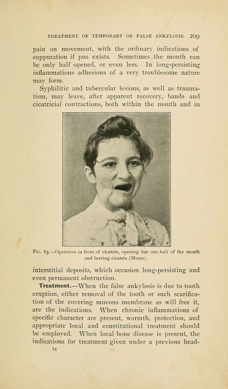 pain on movement, with the ordinary indications of suppuration if pus exists. Sometimes the mouth can be only half opened, or even less. In long-persisting inflammations adhesions of a very troublesome nature may form. Syphilitic and tubercular lesions, as well as trauma- tism, may leave, after apparent recovery, bands and cicatricial contractions, both within the mouth and in Fig. 63.—Operation in front of cicatrix, opening but one-half of the mouth and leaving cicatrix (Mears). interstitial deposits, which occasion long-persisting and even permanent obstruction. Treatment.—When the false ankylosis is due to tooth eruption, either removal of the tooth or such scarifica- tion of the covering mucous membrane as will free it, are the indications. When chronic inflammations of specific character are present, w^armth, protection, and appropriate local and constitutional treatment should be employed. When local bone disease is present, the indications for treatment given under a previous liead- 14