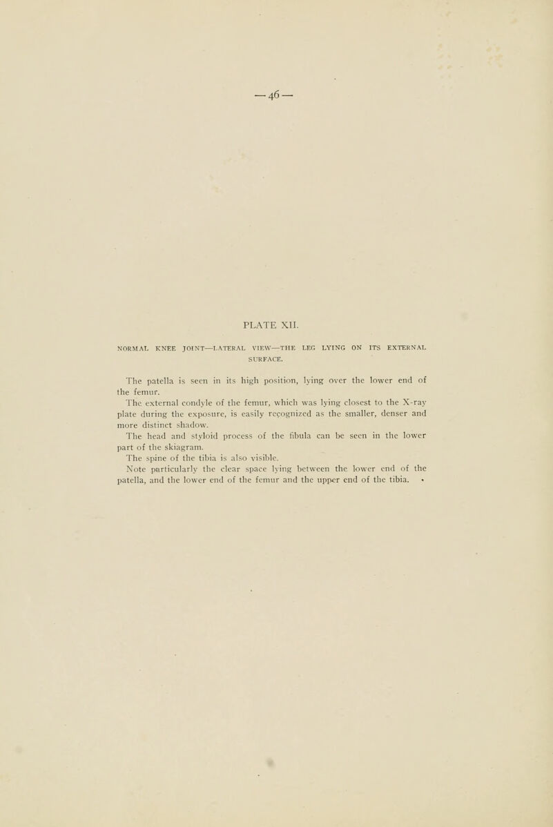 ■46- PLATE XII. NORMAL KNEE JOINT—LATERAL VIEW—THE LEG LYING ON ITS EXTERNAL SURFACE. The patella is seen in its high position, lying over the lower end of the femur. The external condyle of the femur, which was lying closest to the X-ray plate during the e.xposure, is easily recognized as the smaller, denser and more distinct .shadow. The head and styloid process of the fibula can be seen in the lower part of the skiagram. The spjne of the tibia is also visible. Note particularly the clear space lying between the lower end of the patella, and the lower end of the femur and the upper end of the tibia. •