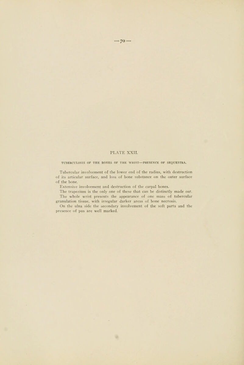 PLATE XXII. TUBERCULOSIS OF THE BONES OF THE WRIST—PRESENCE OF SEQUESTRA. Tubercular involvement o{ the lower end of the radius, with destruction of its articular surface, and loss of bone substance on the outer surface of the bone. Extensive involvement and destruction of the carpal bones. The trapezium is the only one of these that can be distinctly made out. The whole wrist presents the appearance of one mass of tubercular granulation tissue, with irregular darker areas of bone necrosis. On the ulna side the secondary involvement of the soft parts and the presence of pus are well marked.