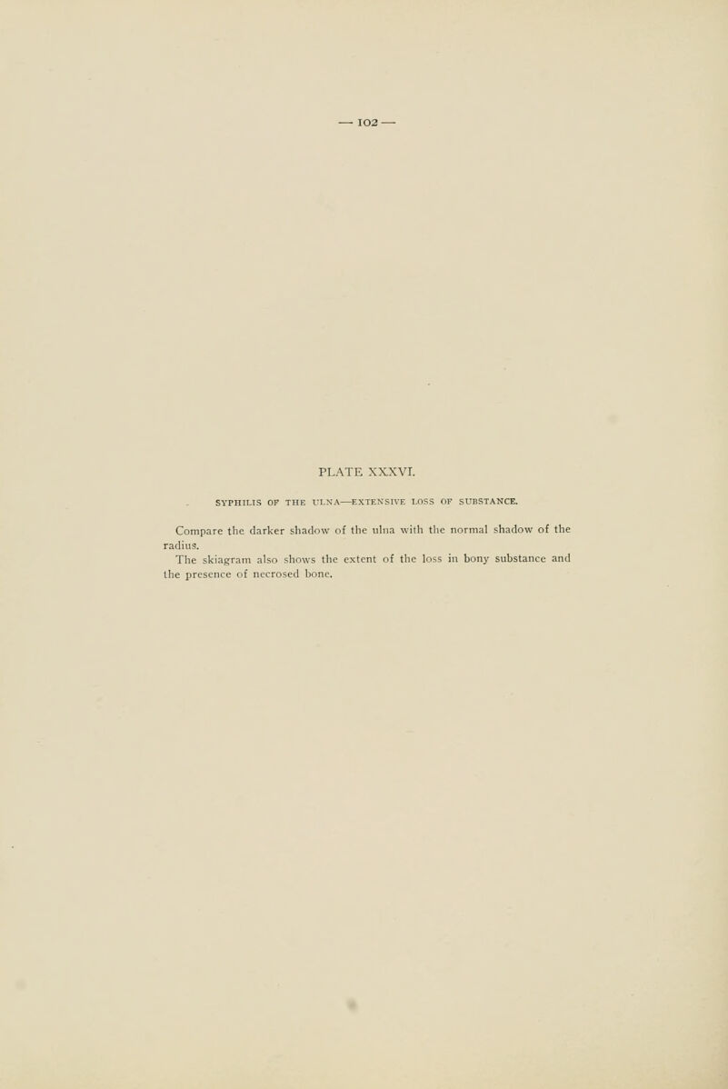 SYPHILIS OF THE UI.NA—EXTENSIVE LOSS OF SUBSTANCE. Compare tbc darker shadow of the ulna with tlie normal shadow of the radius. The skiagram also shows the extent of the loss in bony substance and the presence of necrosed bone.