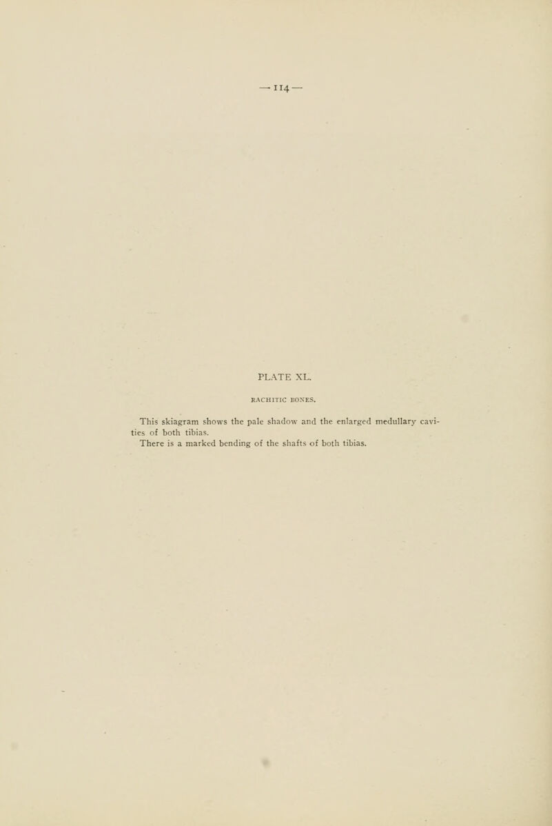 PLATE XL. RACHITIC BOXES. This skiagram shows the pale shadow and the enlarged medullary cavi- ties of both tibias. There is a marked bending of the shafts of both tibias.