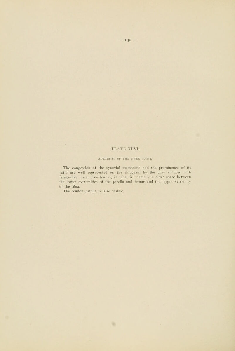 — 132- PLATE XLVI. ARTHRITIS OF THE KXEE JOINT. The congestion of the synovial membrane and the prominence of its tufts are well represented on the skiagram by the gray shadow with fringe-like lower free border, in what is normally a clear space between the lower extremities of the patella and femur and the upper extremity of the tibia. The tendon patella is also visible.