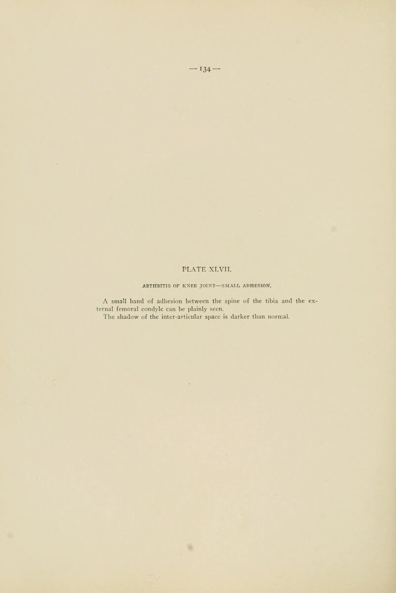 — 134- PLATE XLVII. ARTHRITIS OF KNEE JOINT—SMALL ADHESION. A small band of adhesion between the spine of the tibia and the ex- ternal femoral condyle can be plainly seen. The shadow of the inter-articular space is darker than normal.