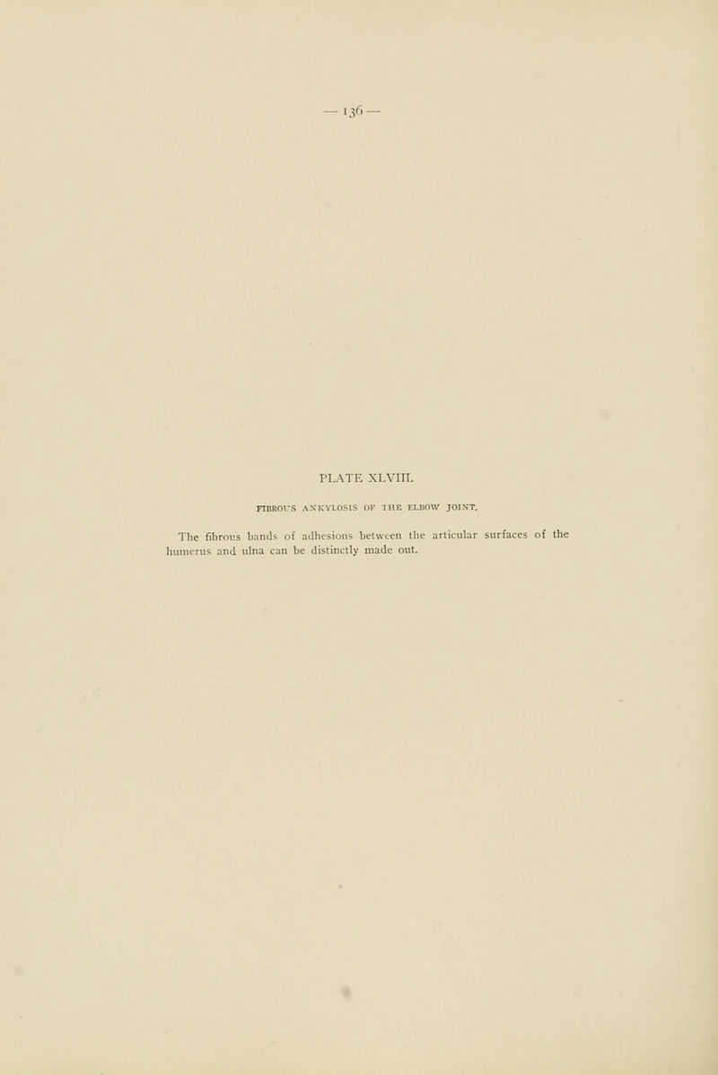 PLATE XLVIII. FIBROUS ANKYLOSIS OF THE ELBOW JOINT. The fibrous bands of adhesions between the articular surfaces of the humerus and ulna can be distinctly made out.