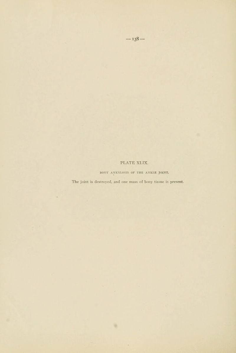 -138- PLATE XLIX. BOXY ANKYLOSIS OF THE AXKLE JOINT. The joint is destroyed, and one mass of bony tissue is present.